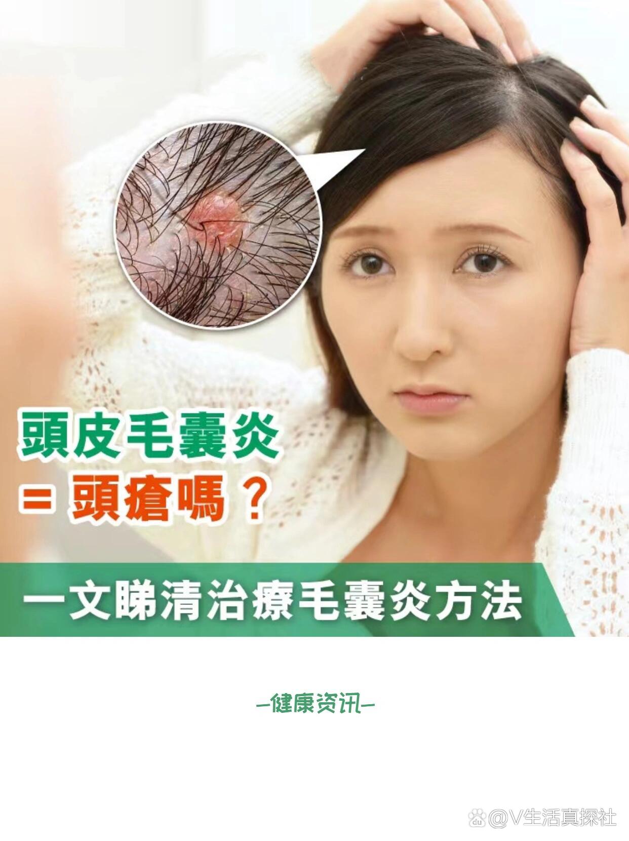 头皮毛囊炎=头疮吗71治疗毛囊炎有什么方法71