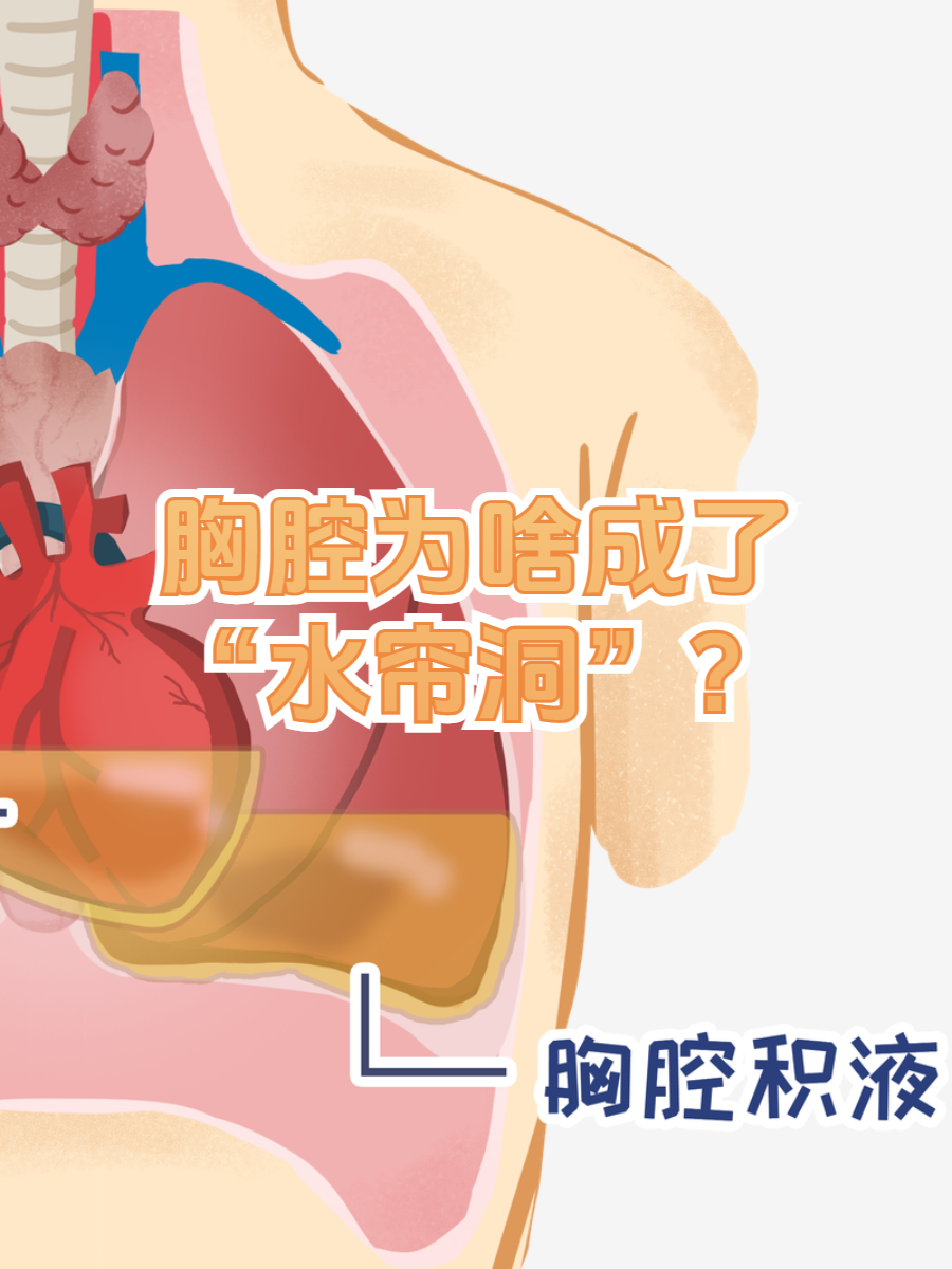 胸腔积液究竟是怎么回事?让我们来揭开谜底
