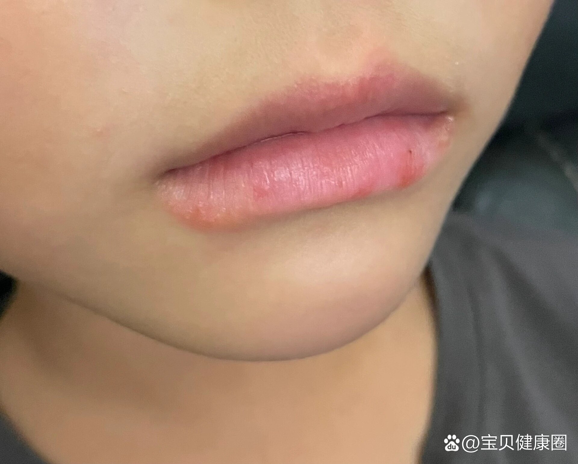 儿童唇炎反复发作