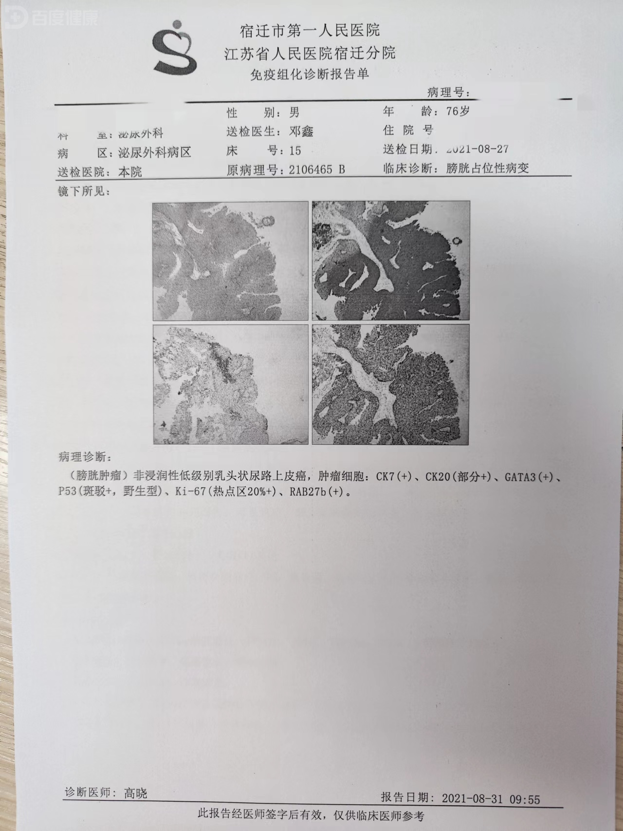 膀胱癌 病理报告图片