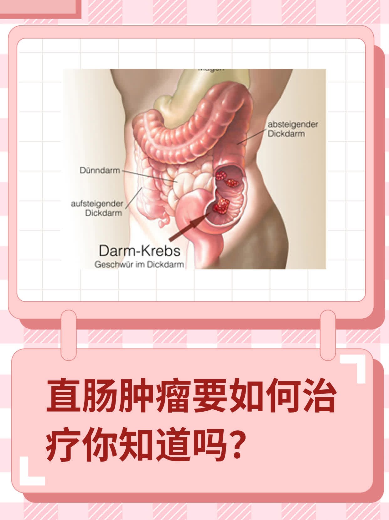 直肠前突最佳治疗方法图片