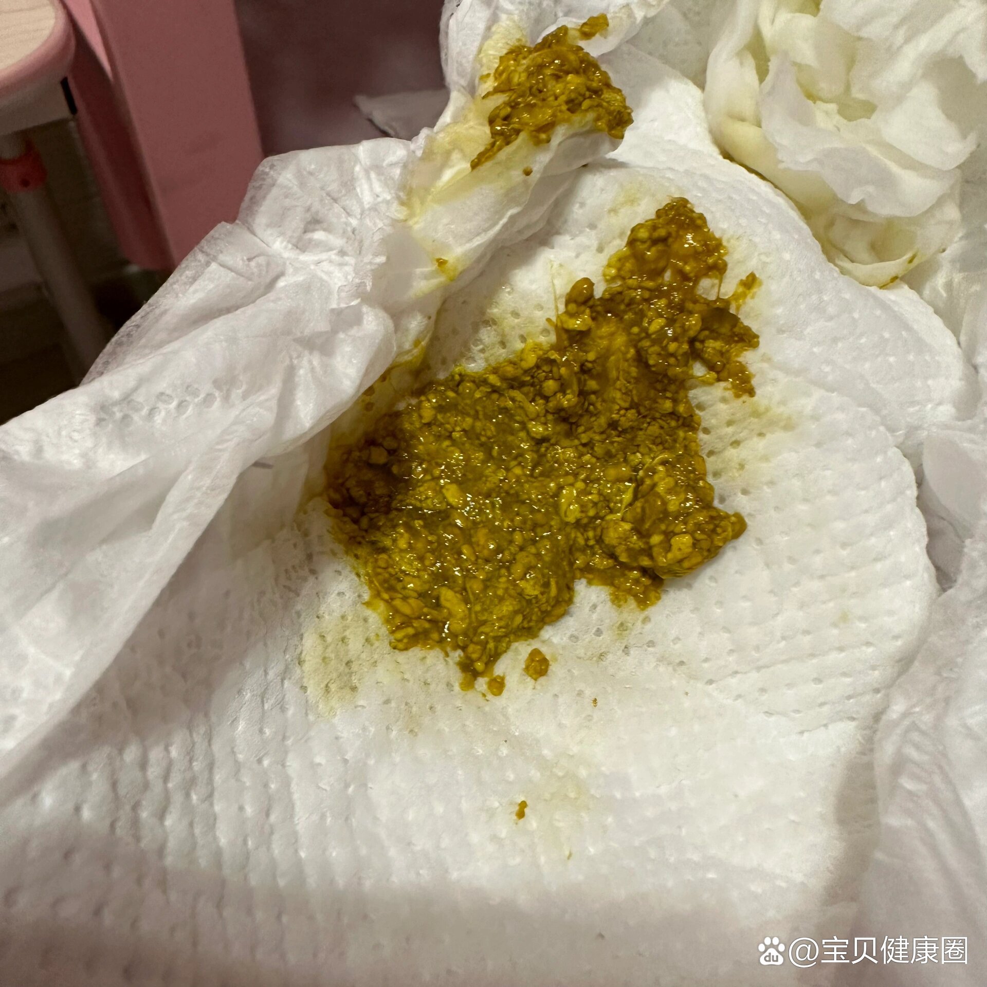 婴儿大便有奶瓣正常吗图片