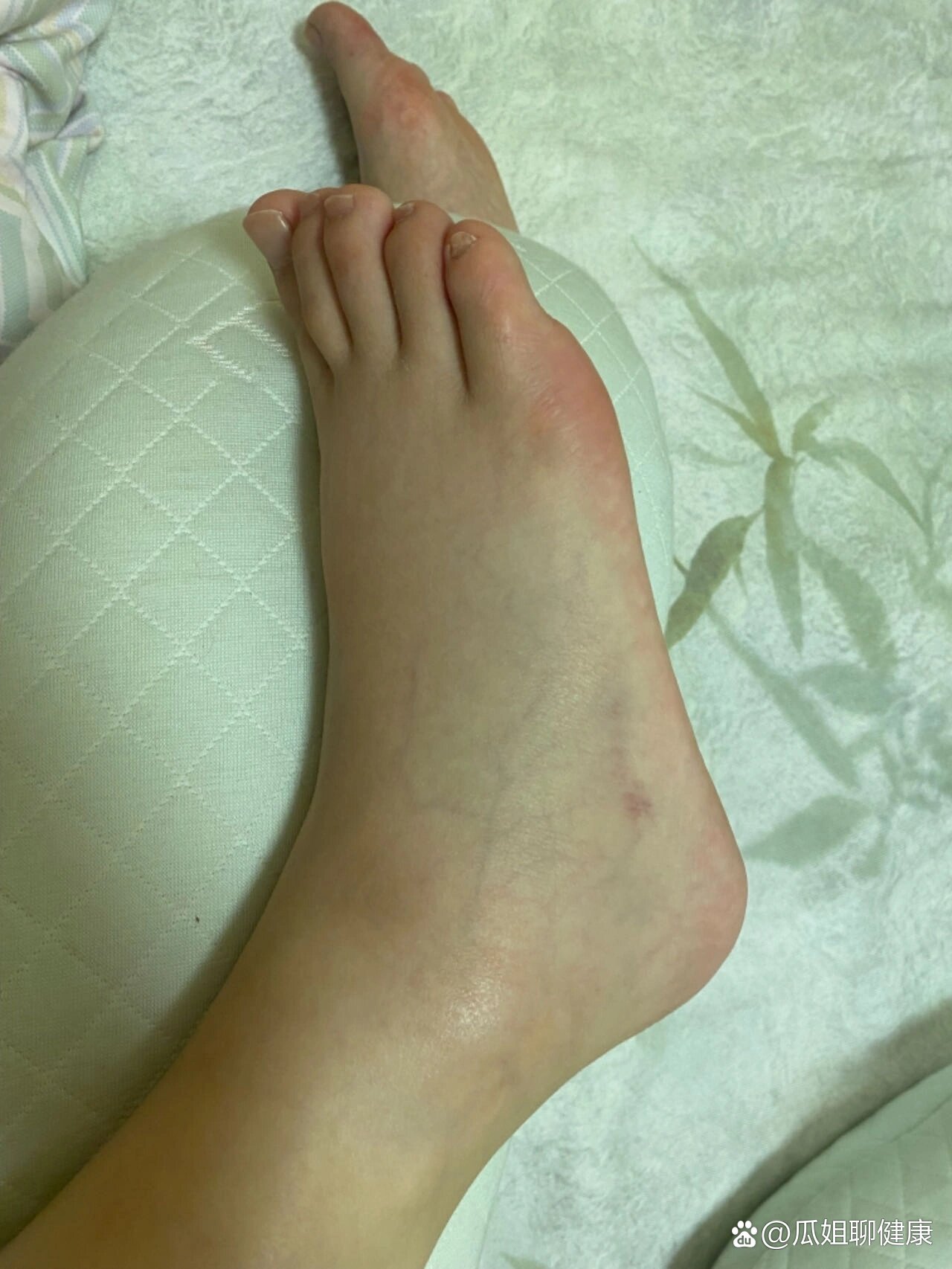 看看你们孕晚期脚肿的照片