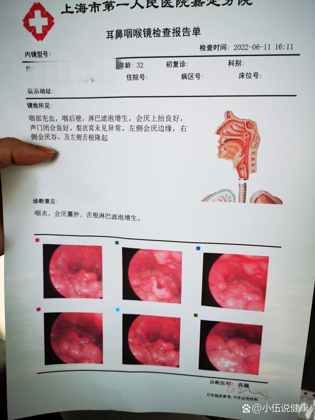 会厌囊肿手术过程图片图片