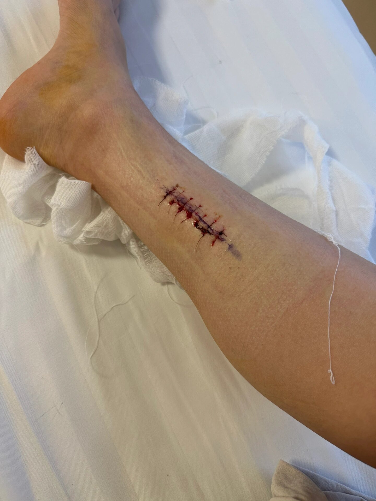 小腿神经鞘瘤手术记