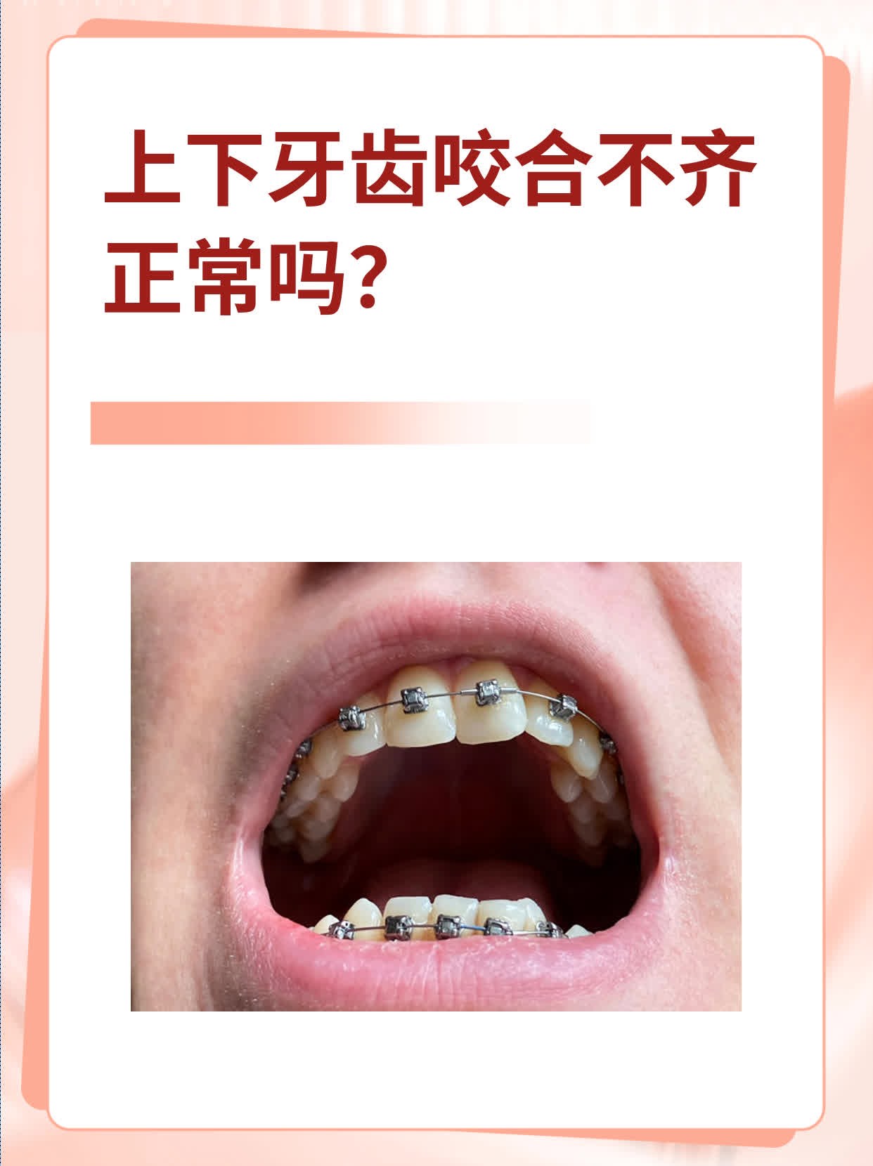 上下牙齿咬合不齐图片图片