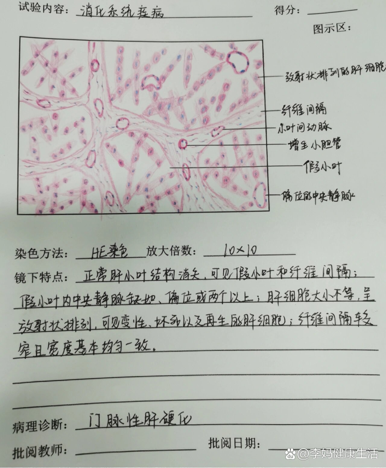 假小叶肝硬化图片