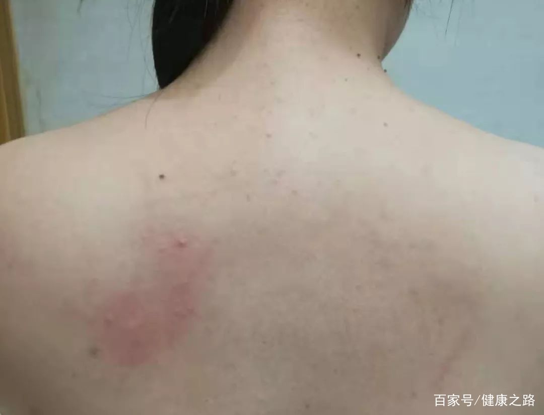 后背有痘痘经常抠它 背上长痘是身体在排毒 可以用手抠掉吗 简明教程
