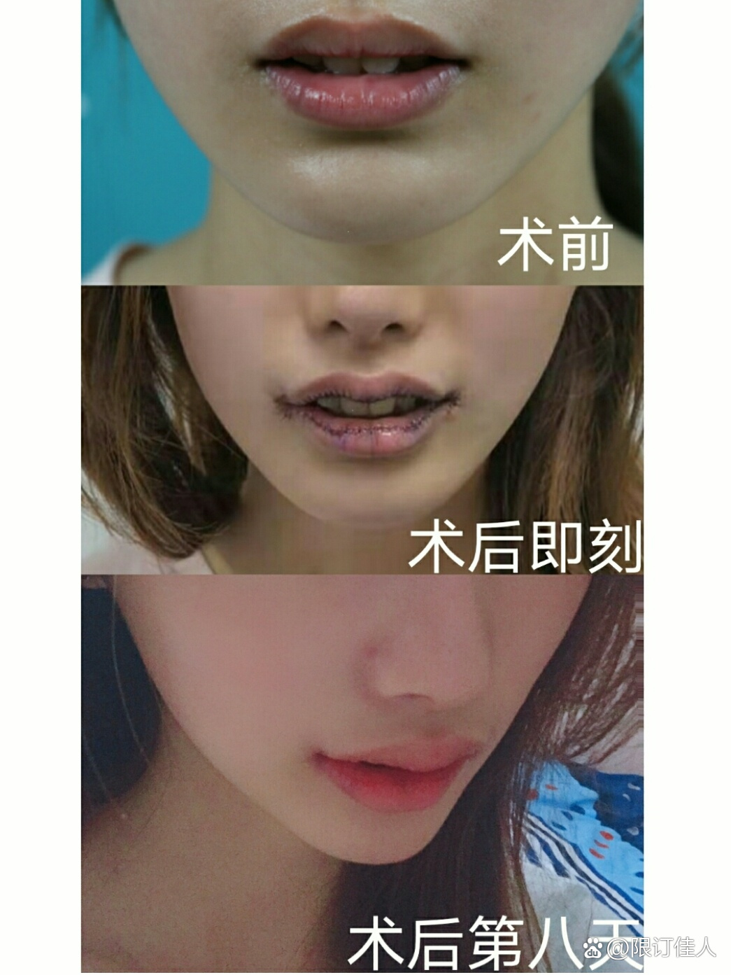 m唇微笑唇 厚唇改薄术后恢复情况