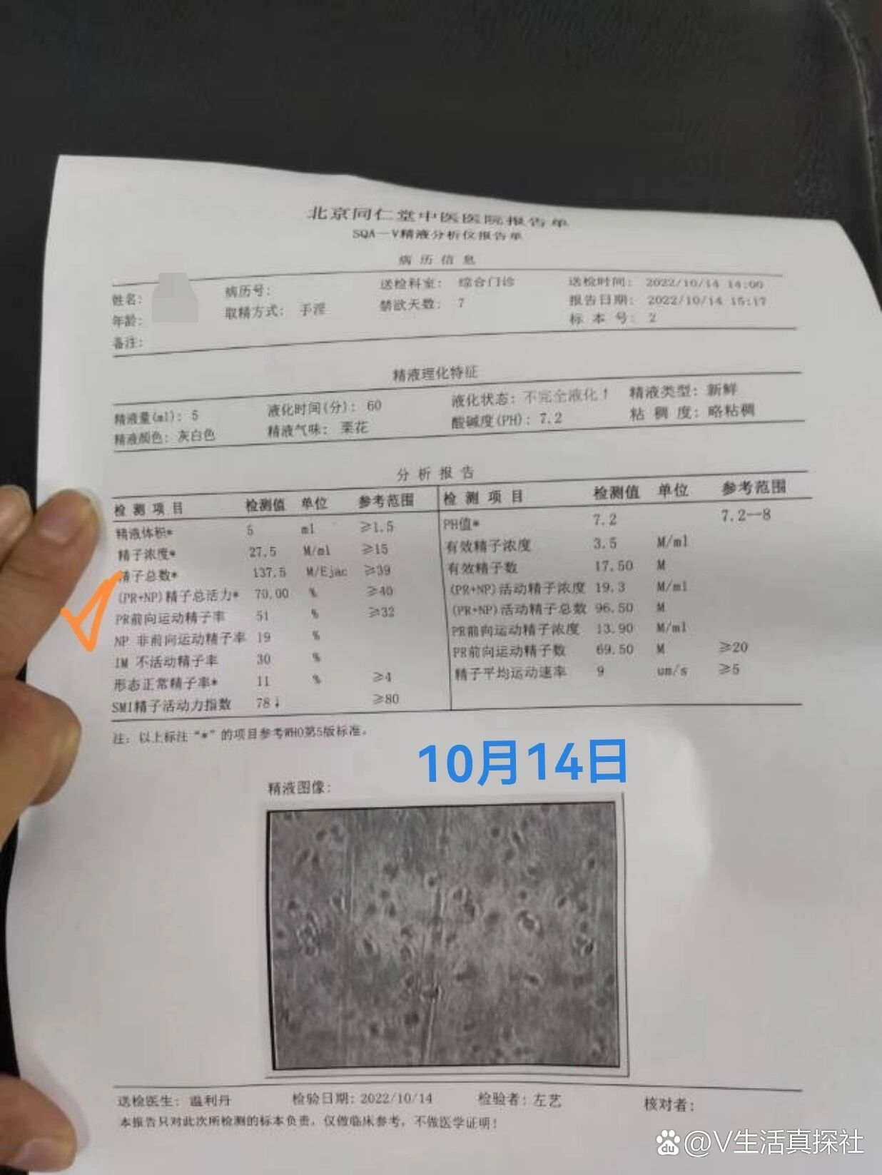 精子活力提升至正常 br>给大家看两张精液常规报告单,鼓励一下因男方
