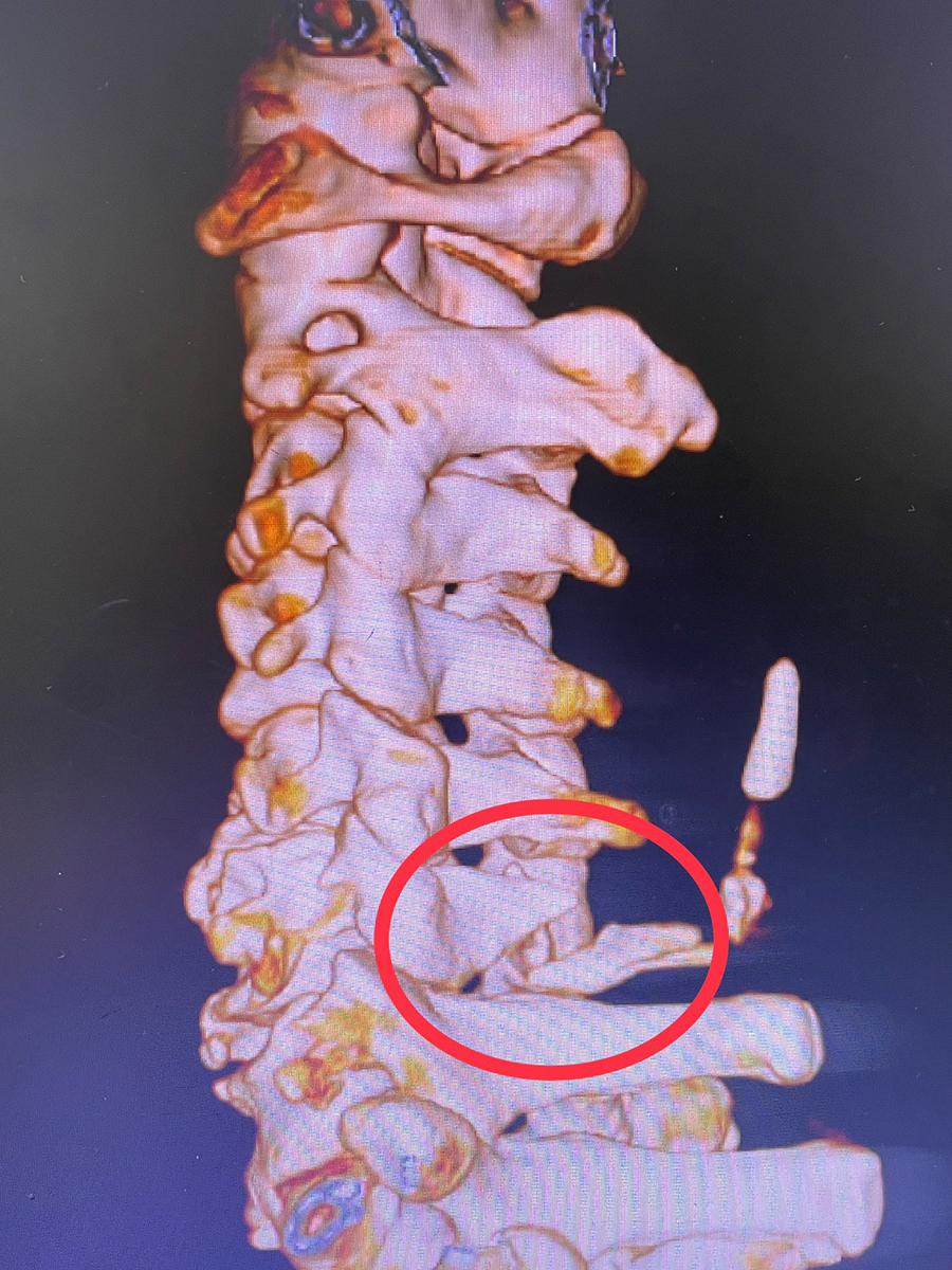 60岁老年男性颈椎骨折伴脱位,需尽快手术及康复训练