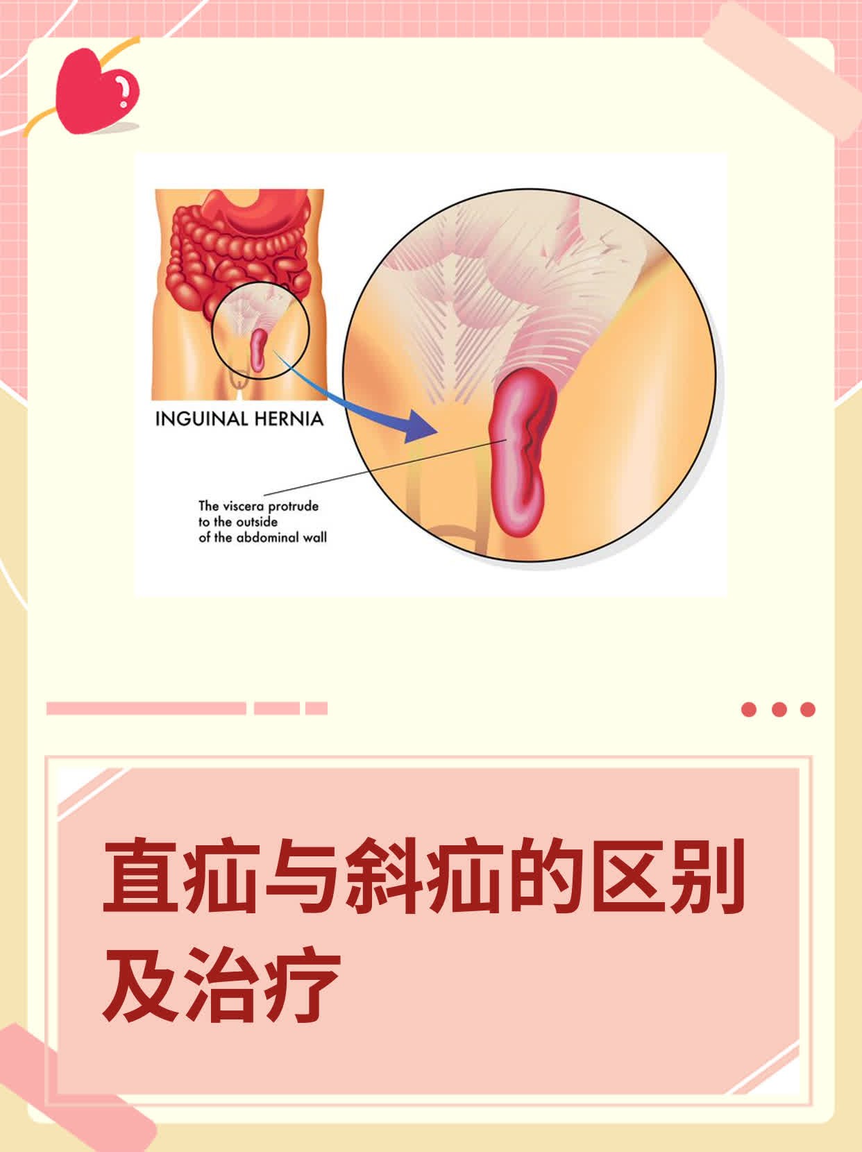 腹股沟斜疝和直疝图解图片