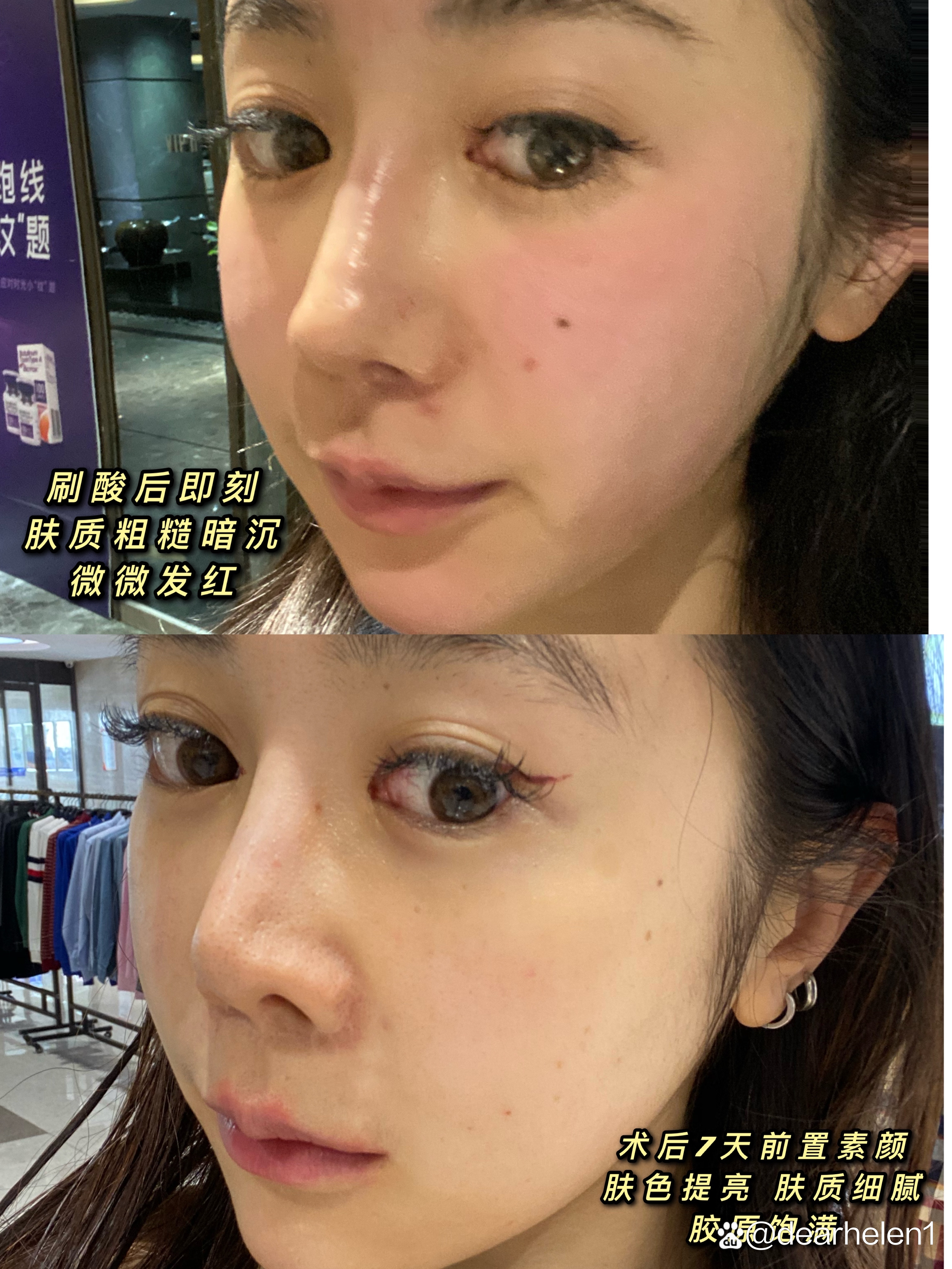 皮肤br我的皮肤没有什么红肿发炎的痘痘但是经常化妆会有一些闭口