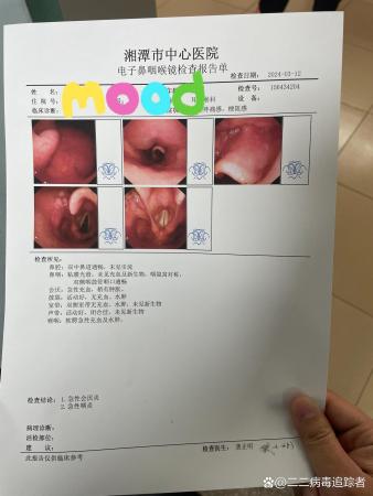 急性会厌炎