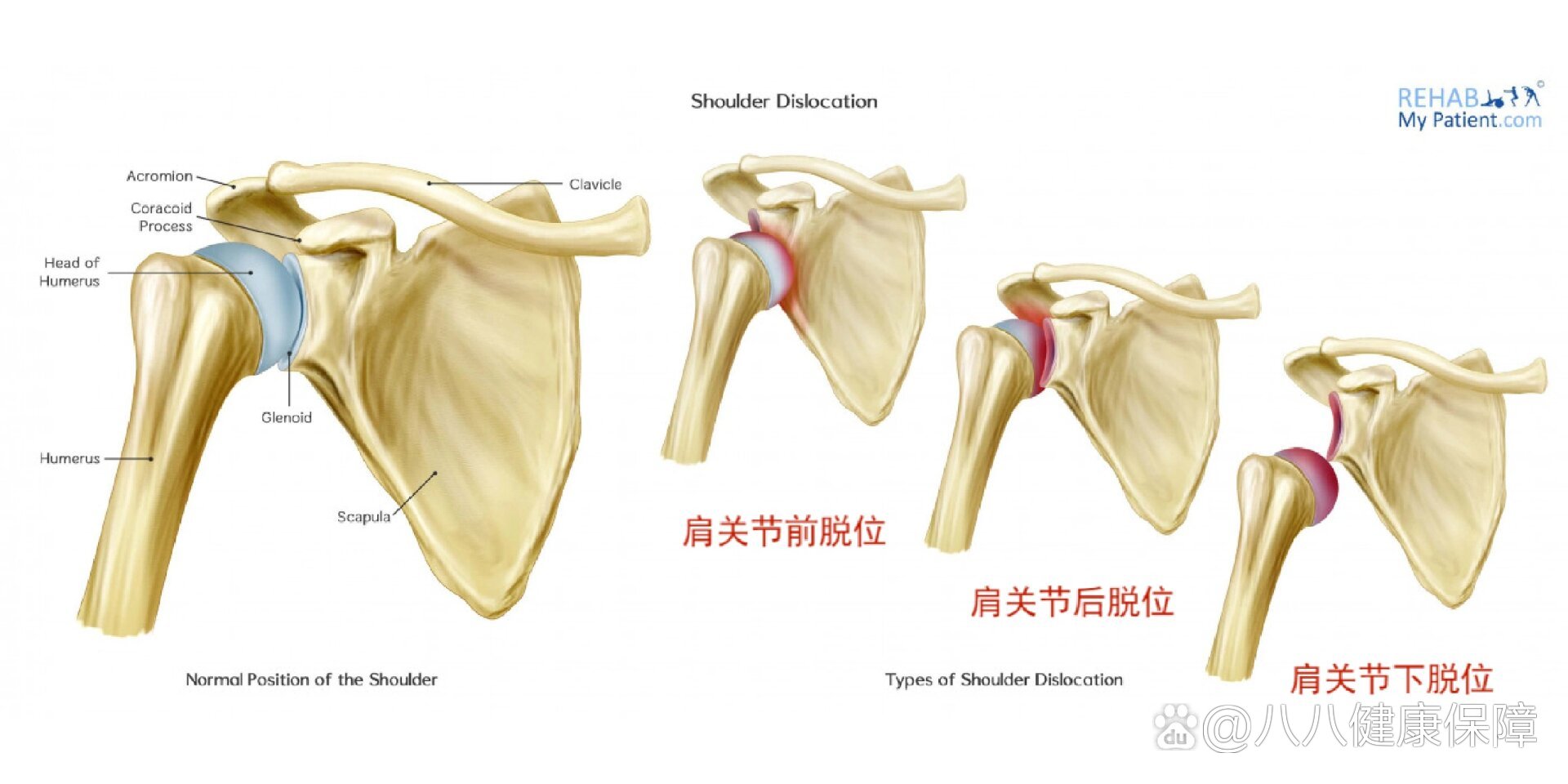 肱二头肌长头肌腱脱位图片