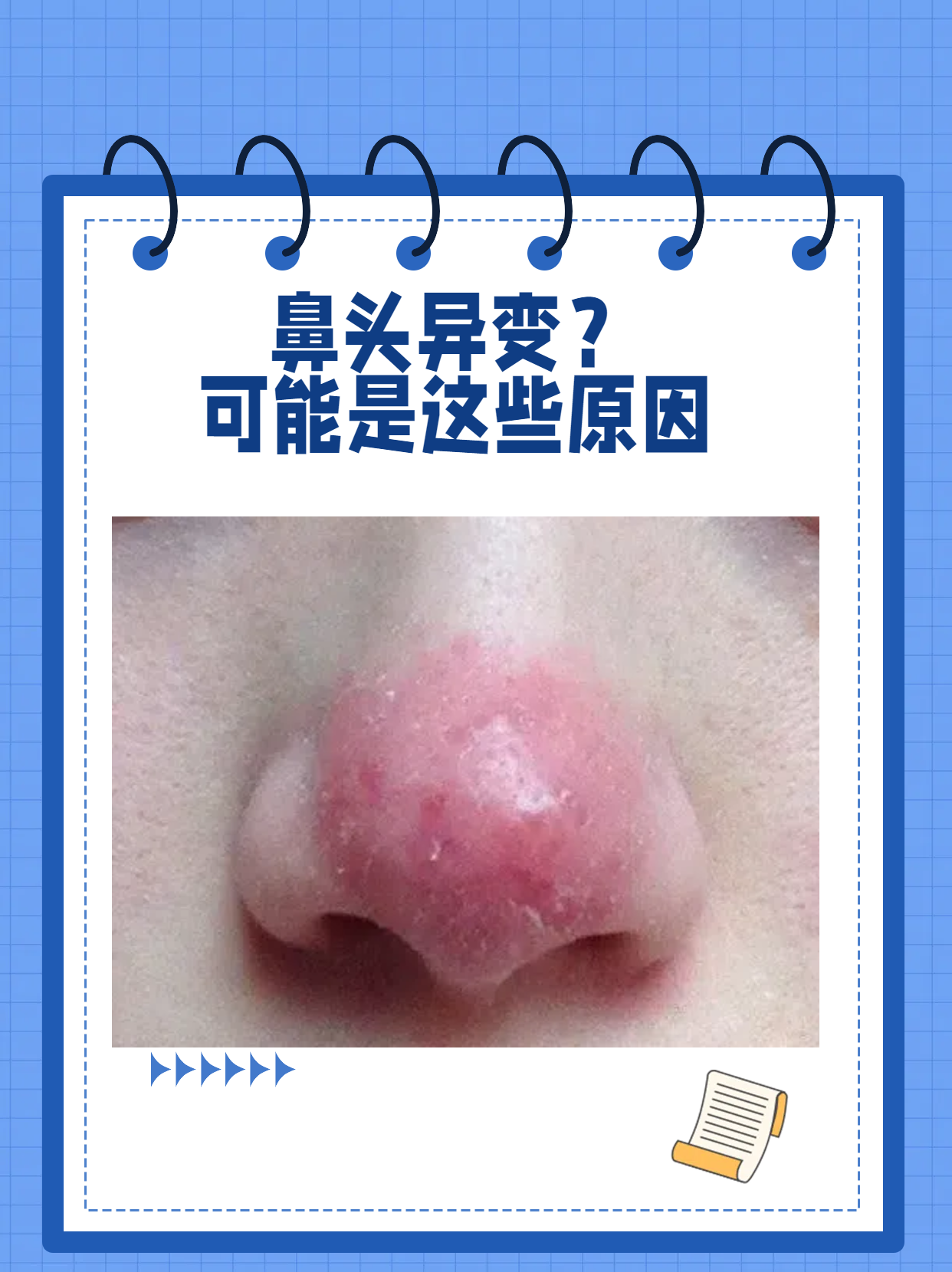 鼻头异变?可能是这些原因