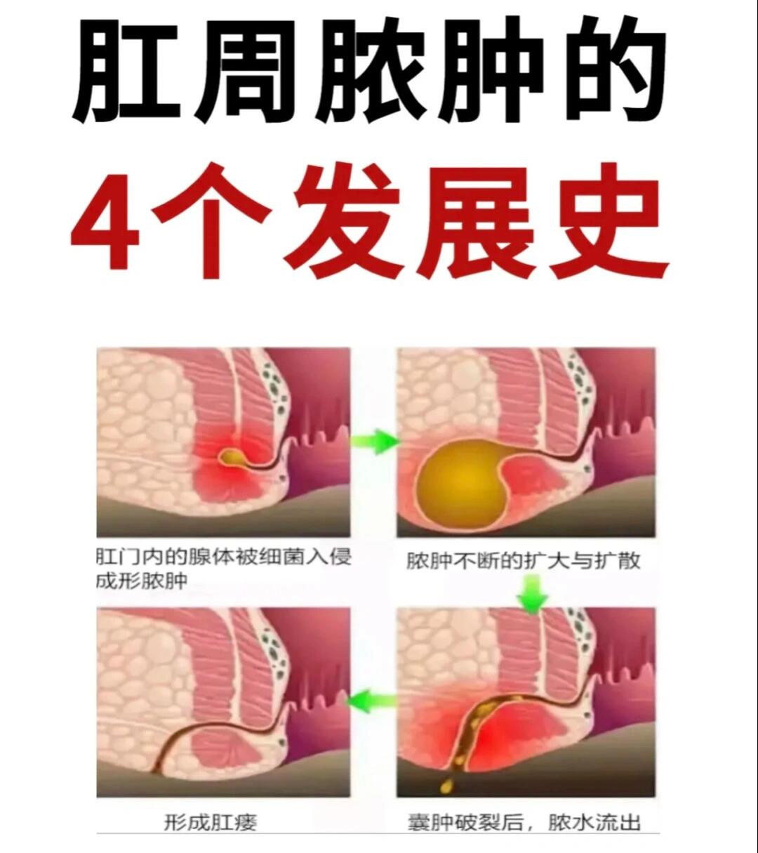 肛瘘手术大概多少钱图片