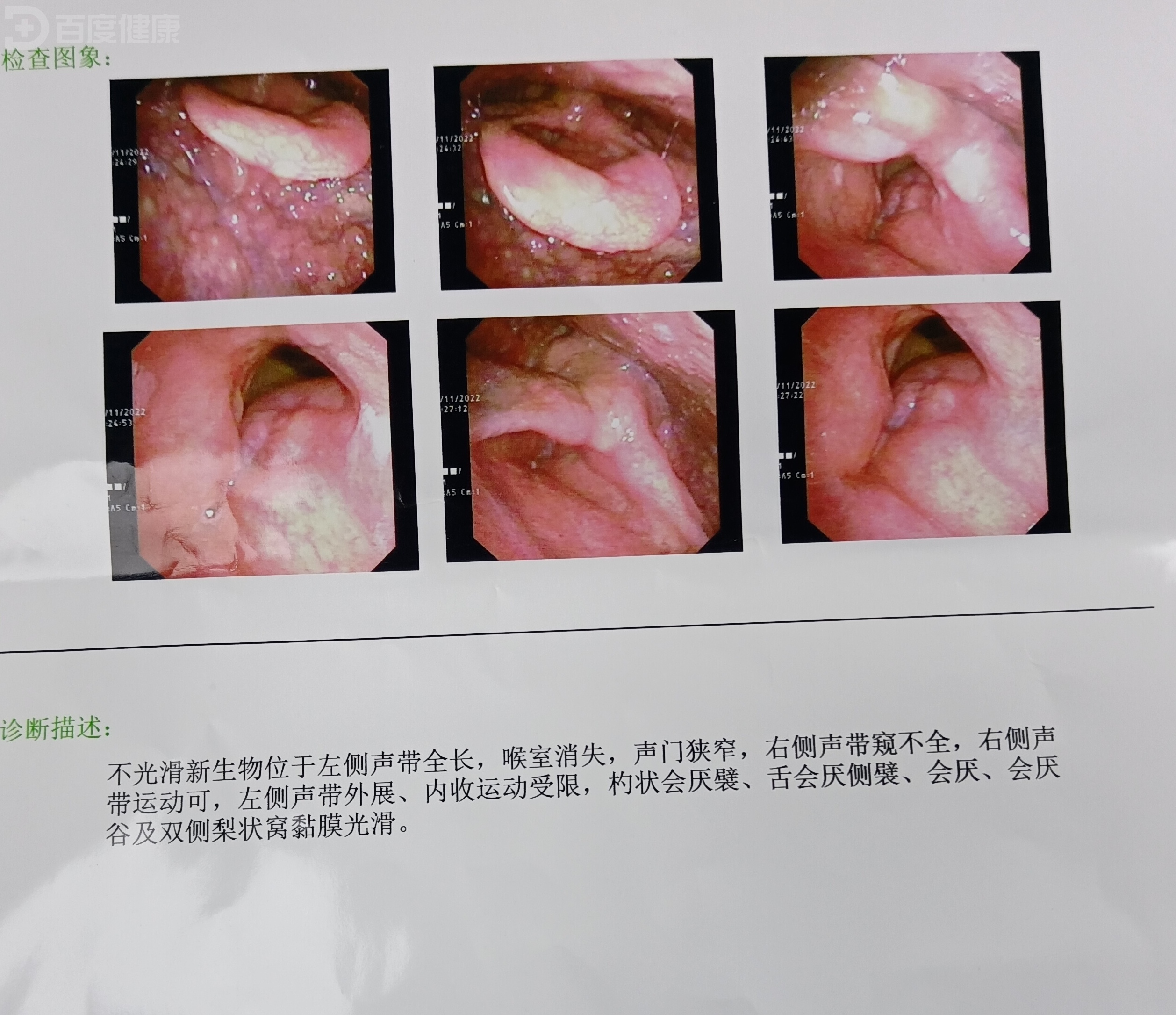 恶性咽喉癌的图片图片