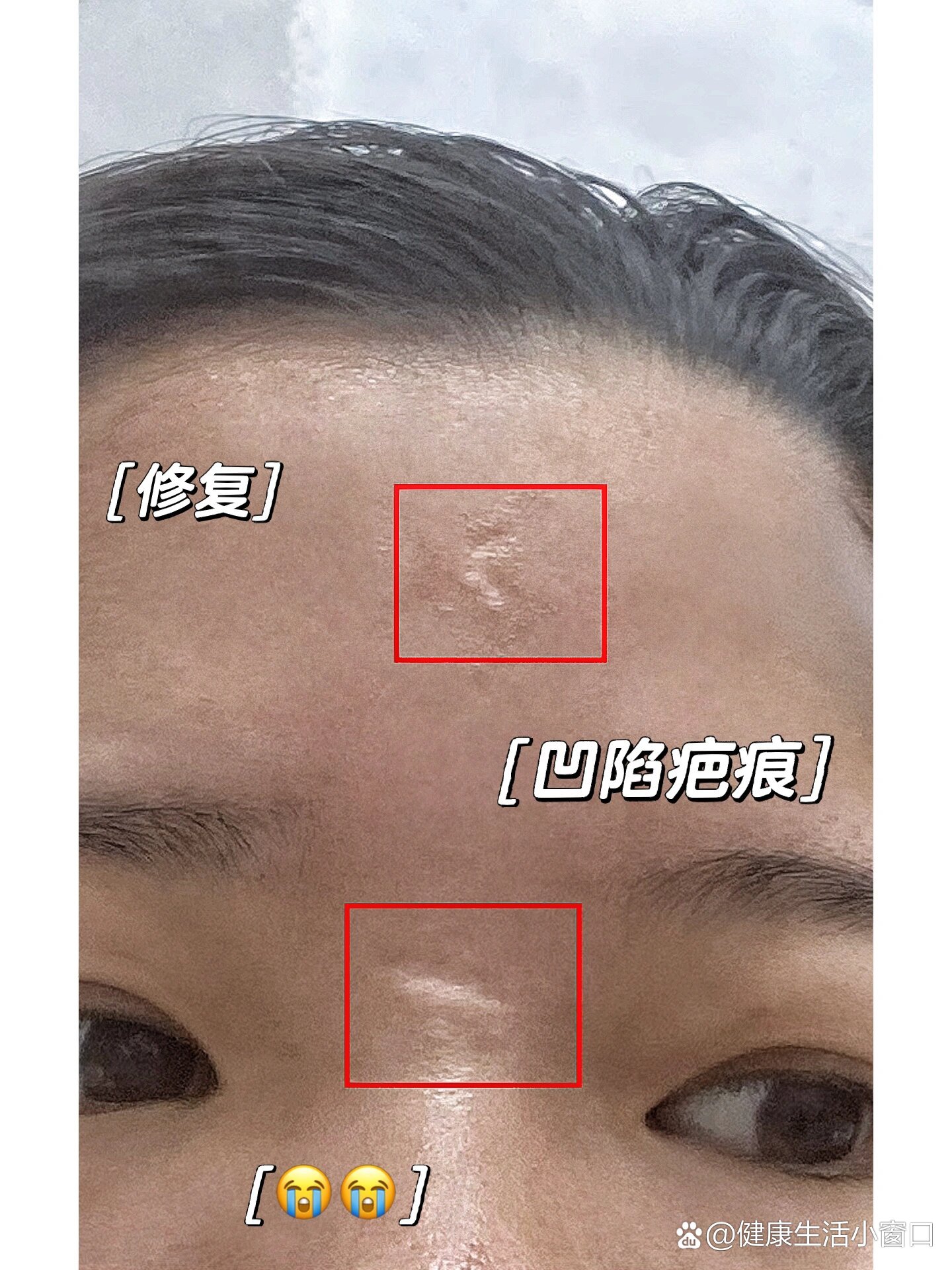 凹陷疤痕能修复吗0101