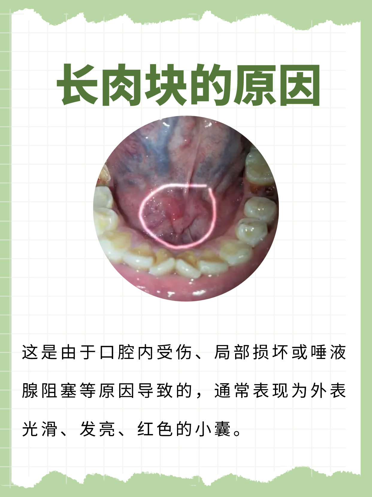 宝宝口腔两侧肉疙瘩图图片