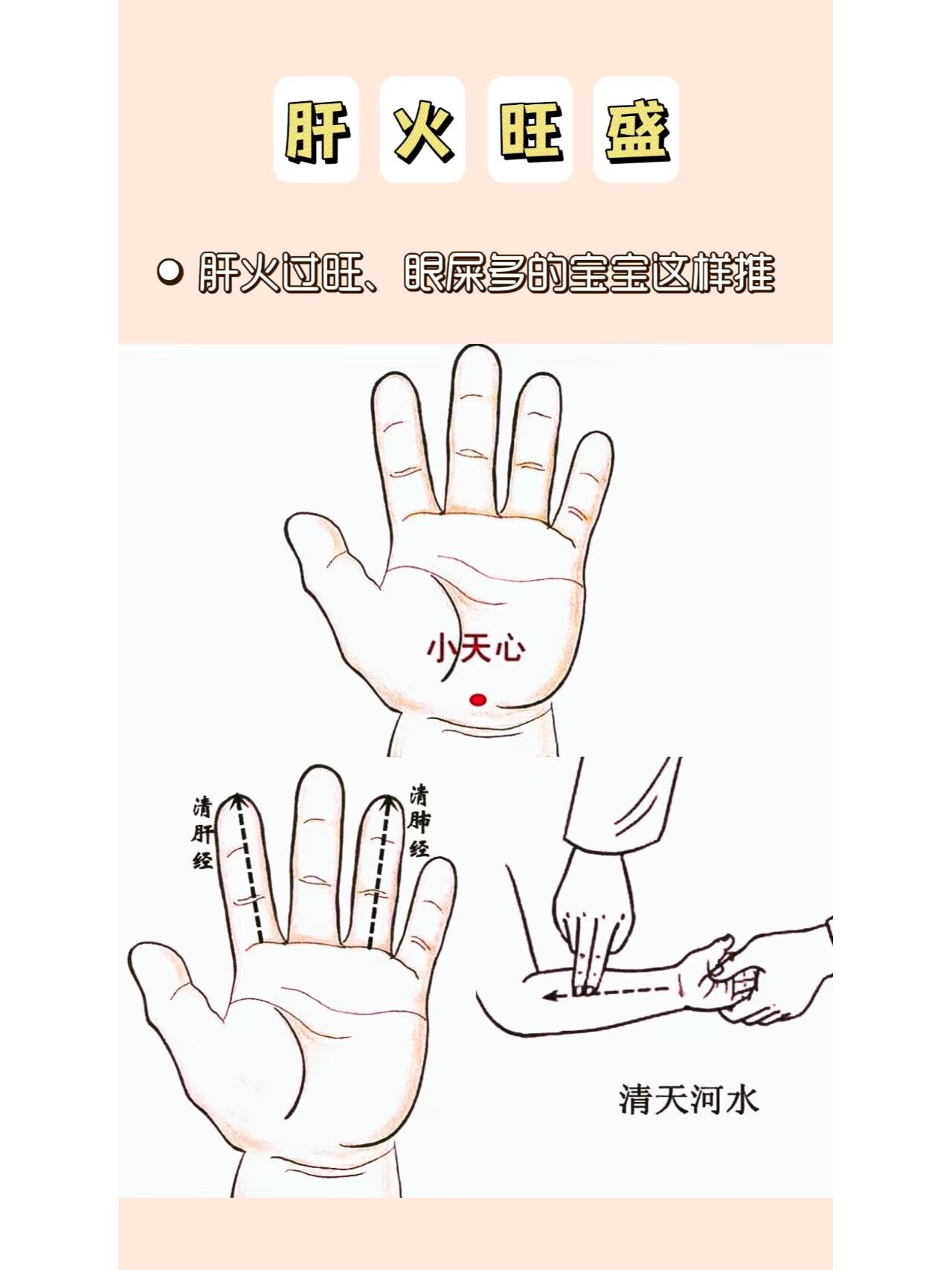 一般是有肝火,往往会伴随脾胃积滞 br>✿推拿方面除了捣小天心之外