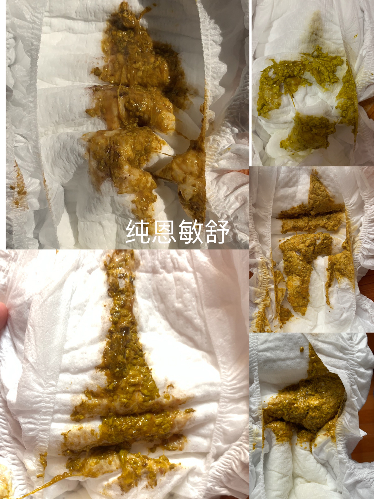 牛奶蛋白过敏的过程及大便图集(一)