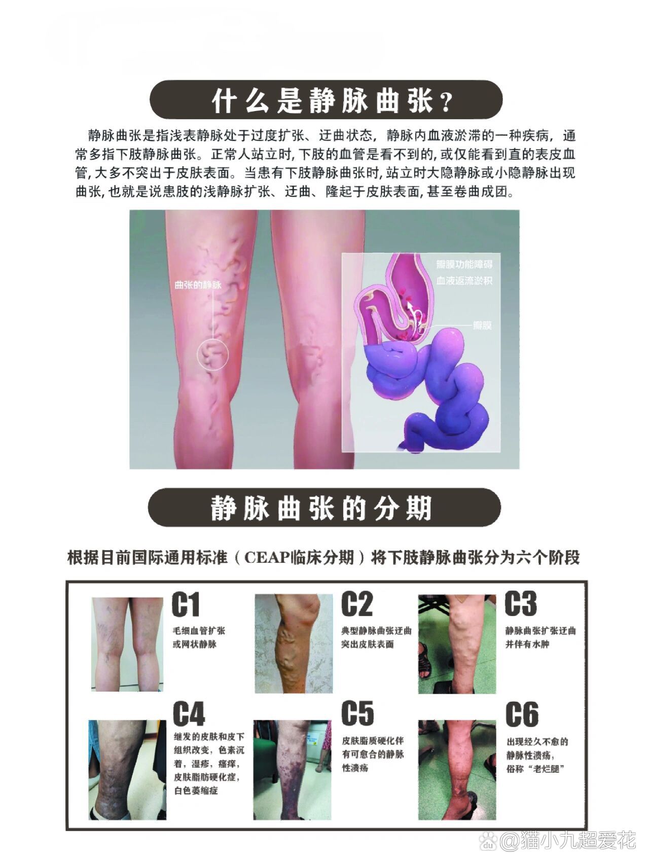 一张图了解静脉曲张,快来看看你的是哪种?