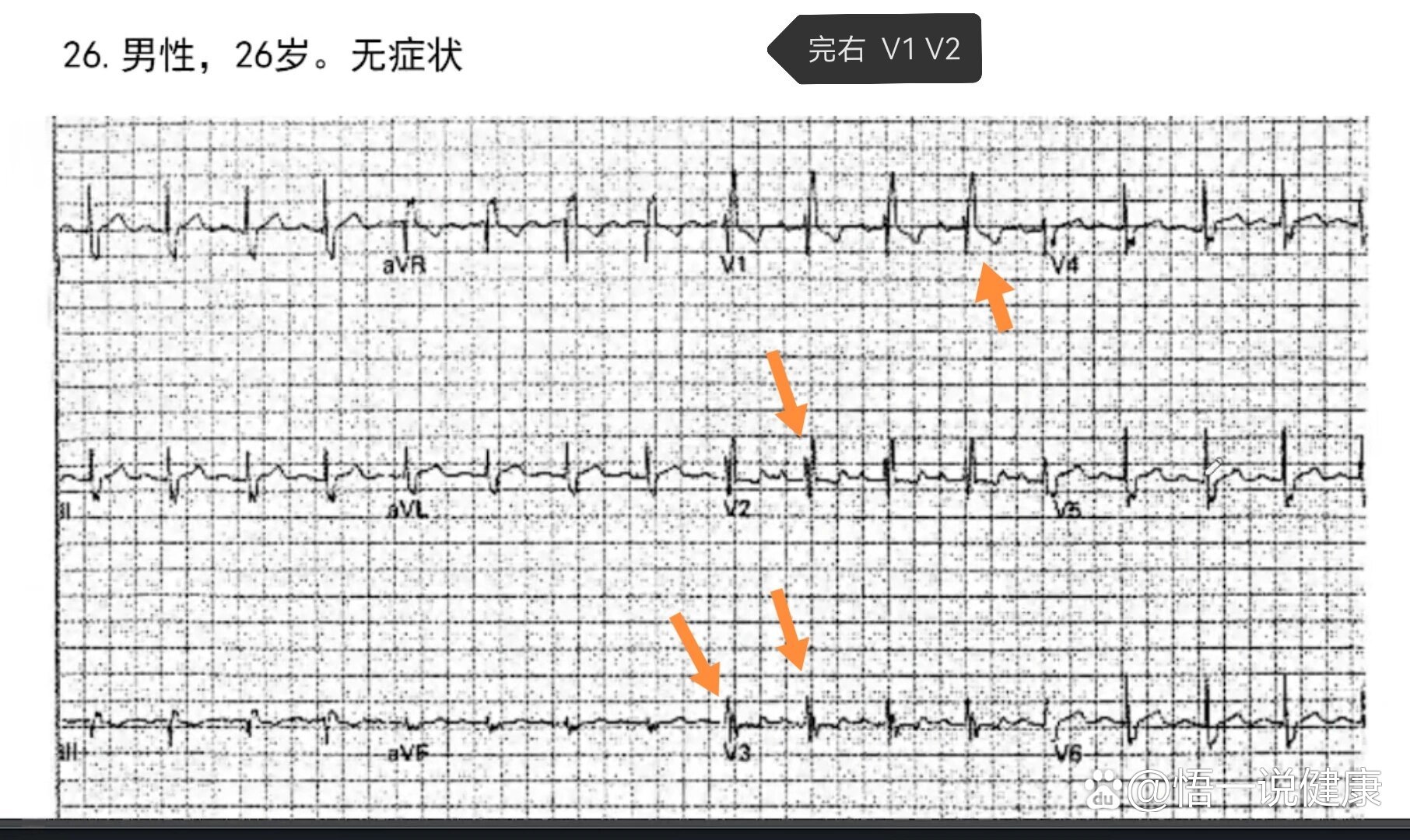在v1v2导联上的波形为rsr,且r波粗钝;v1,v2,v3导联qrs呈m型,此为最