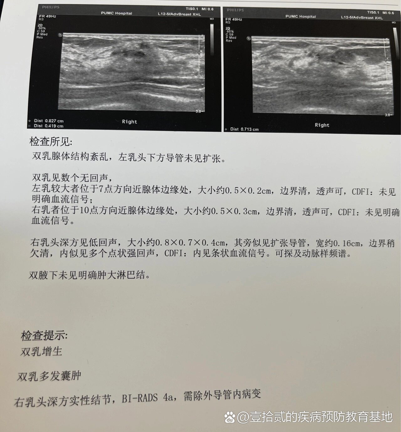 的号做了钼靶和彩超钼靶出结果了不知道为什么又显示4a又显示3