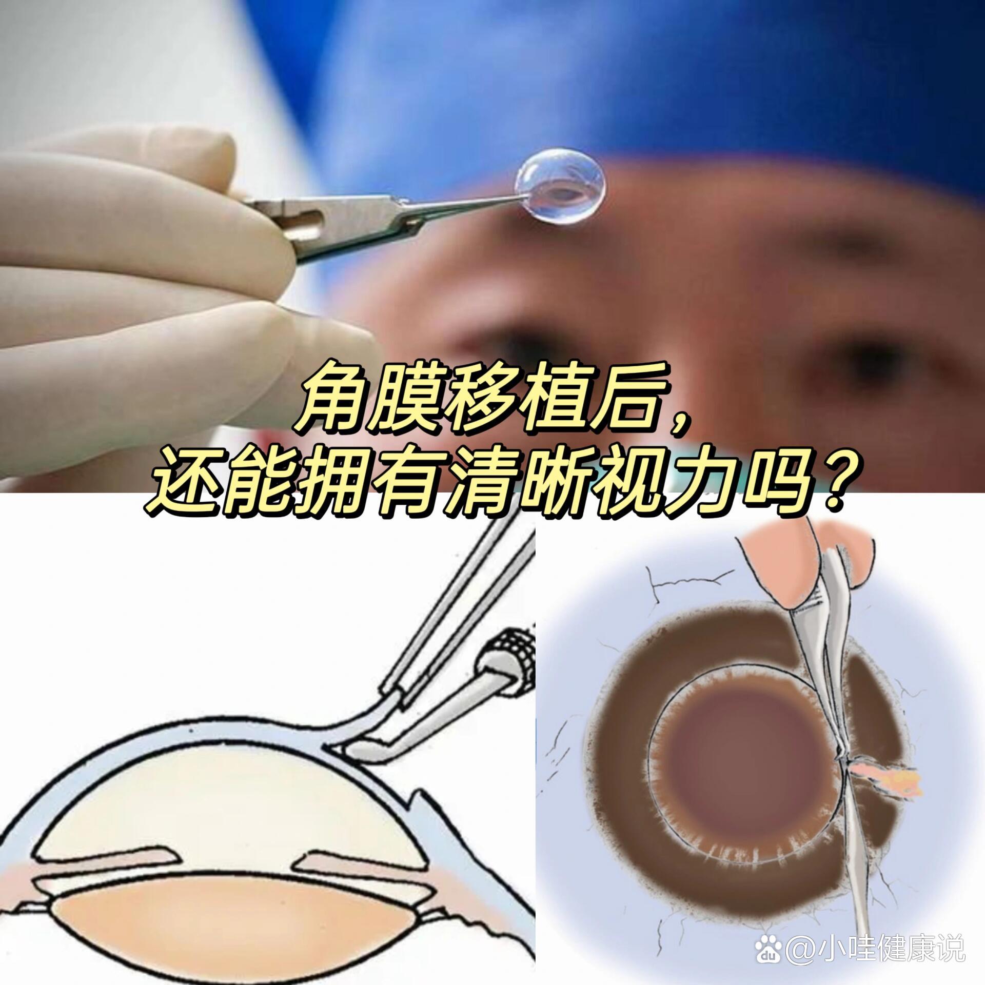 角膜移植后,可以再次拥有清晰视力了吗?