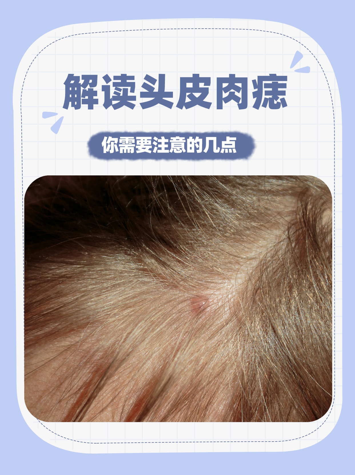 解读头皮肉痣:你需要注意的几点