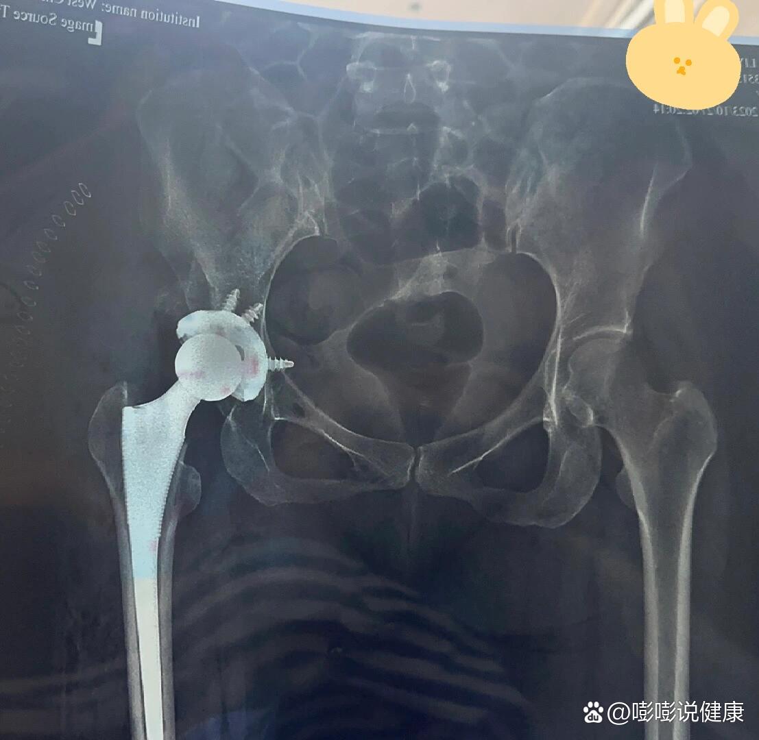 髋关节高脱置换术前术后对比