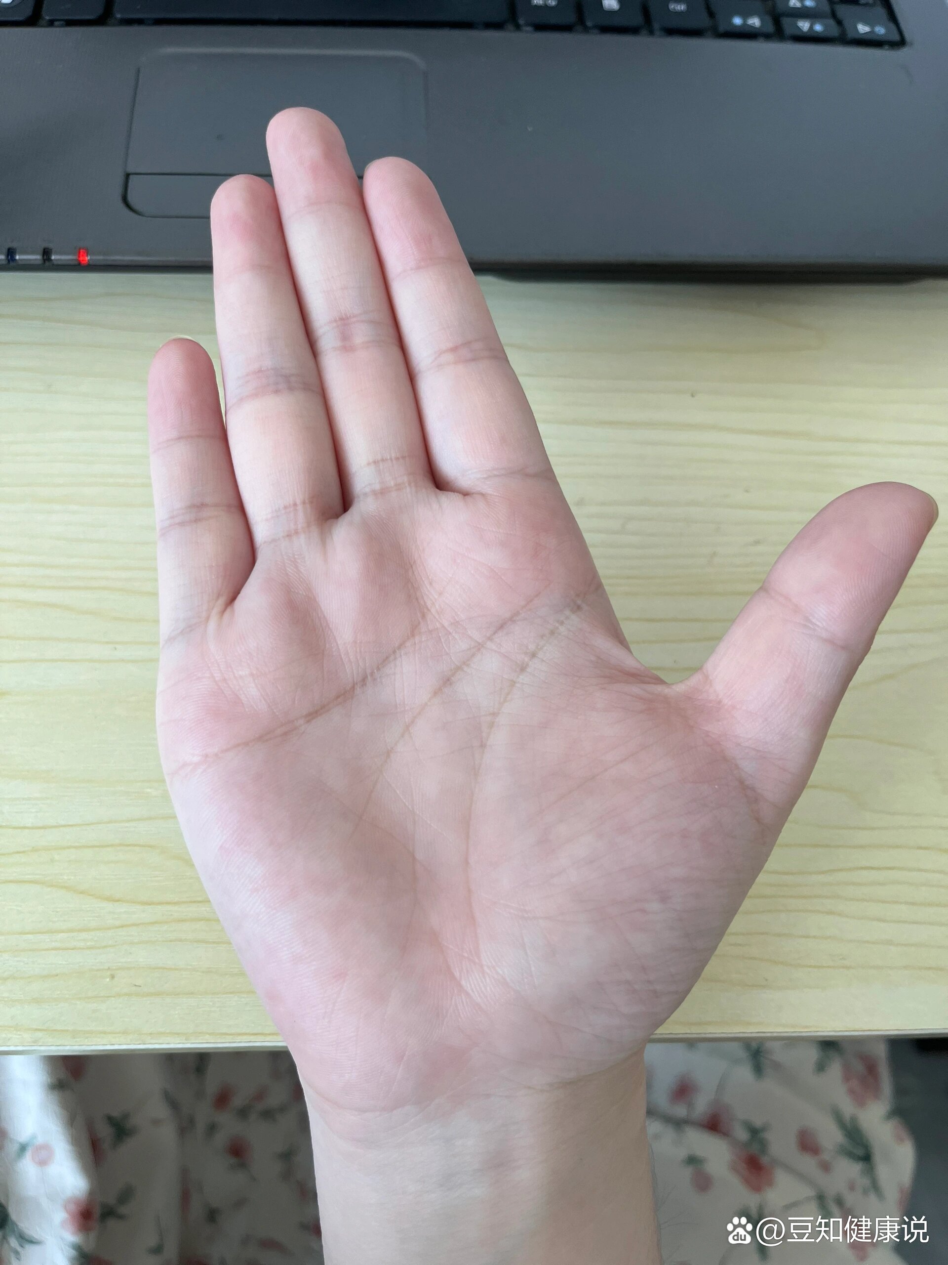 孕期手掌变红微肿