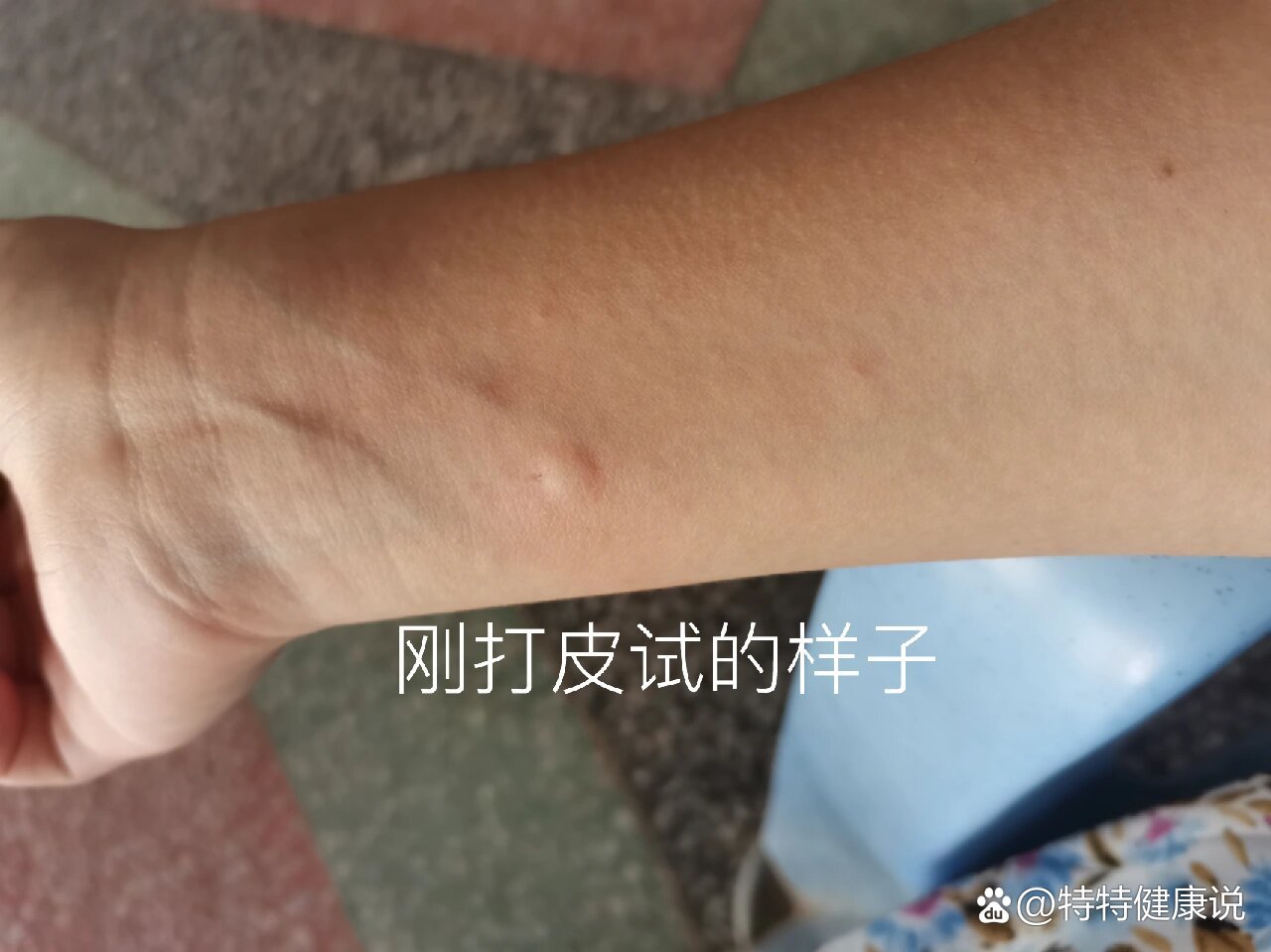 破伤风皮试怎么看是否过敏?