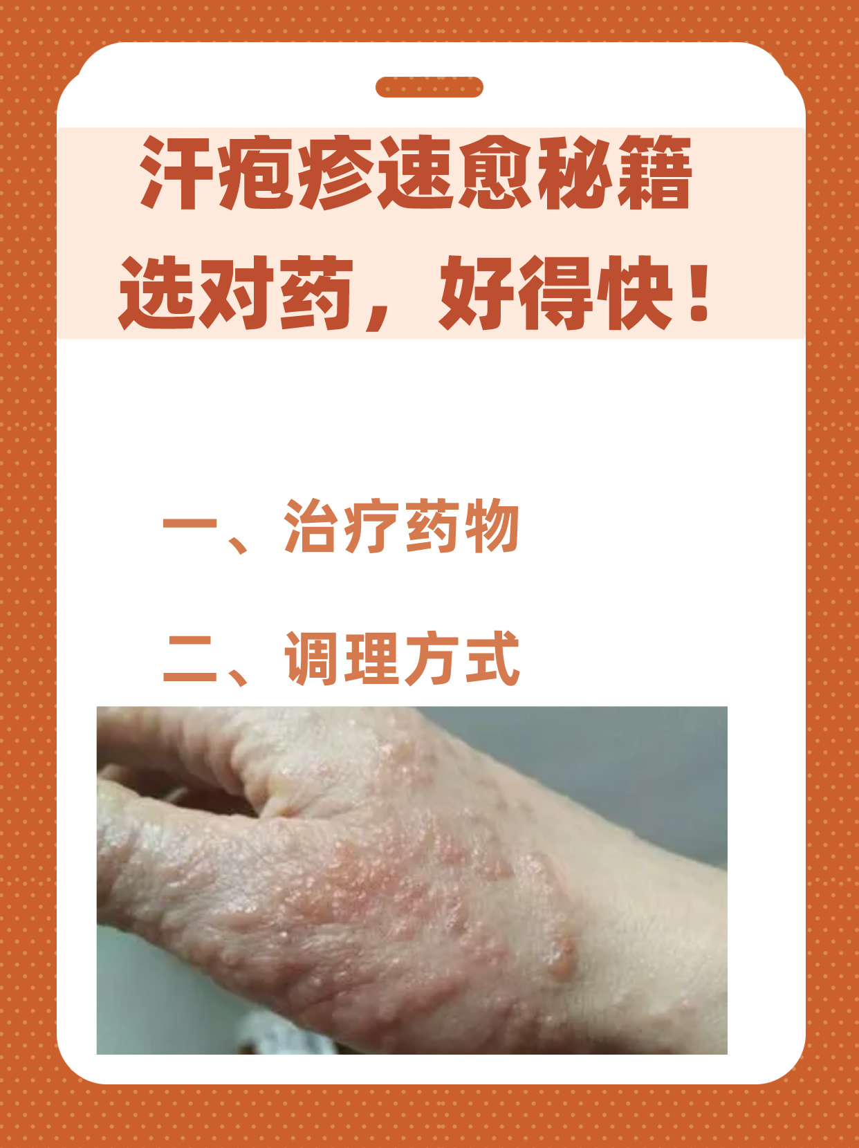 汗疱疹速愈秘籍:选对药,好得快!