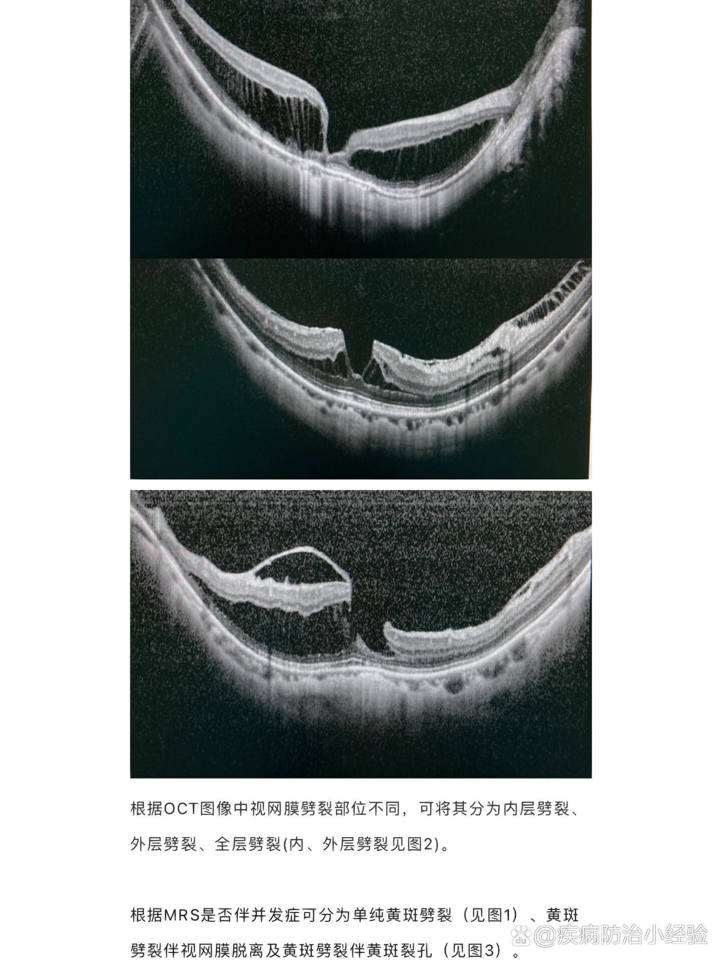 黄斑病变的oct图解合集(一)