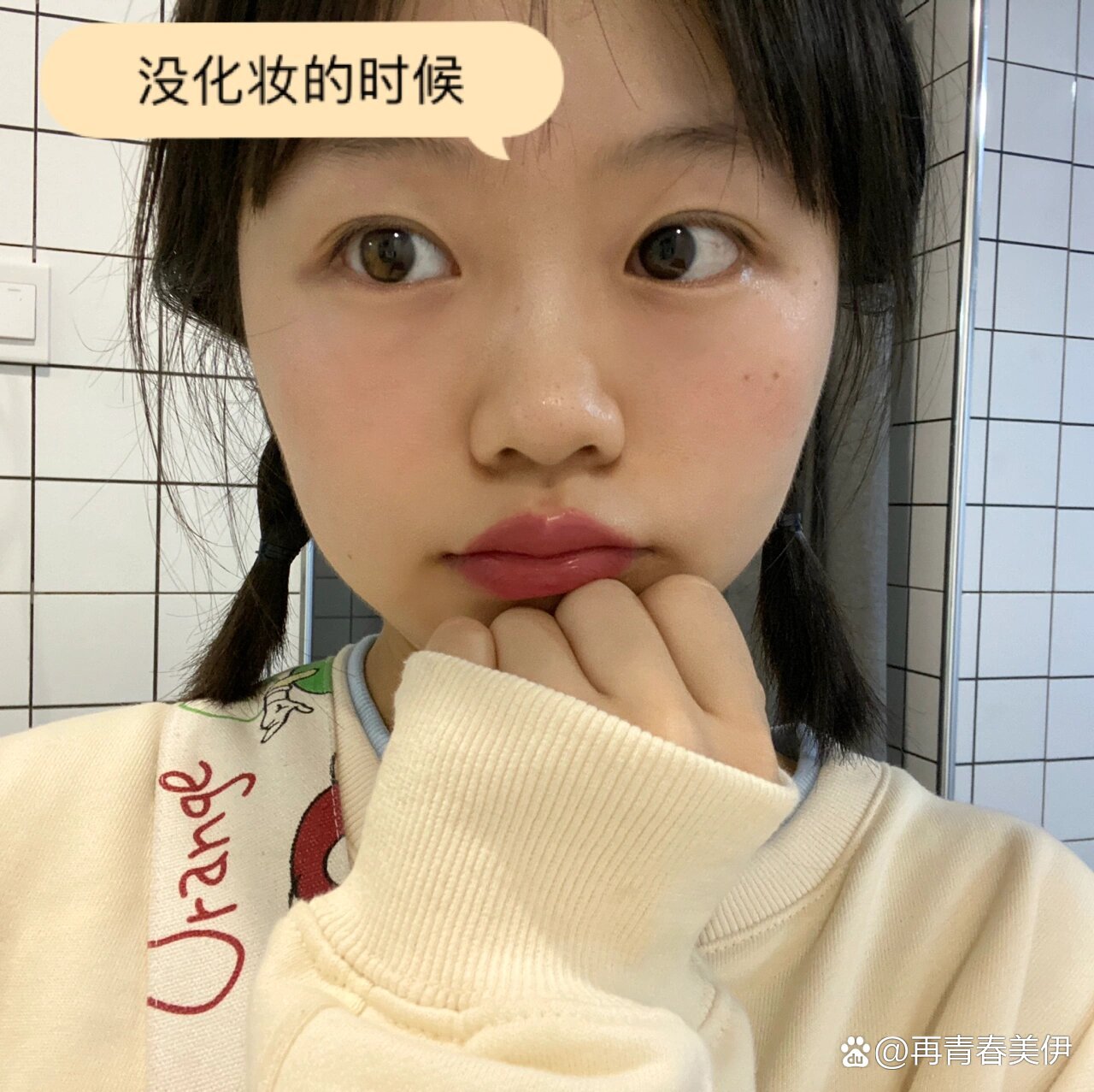 做完埋线双眼皮五年之后