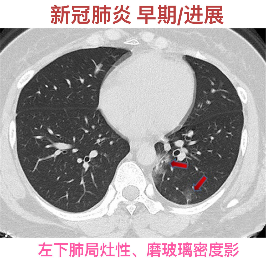  p>新冠肺炎的ct影像学表现 br>新冠肺炎即新型冠状病毒肺炎 br>	 br>