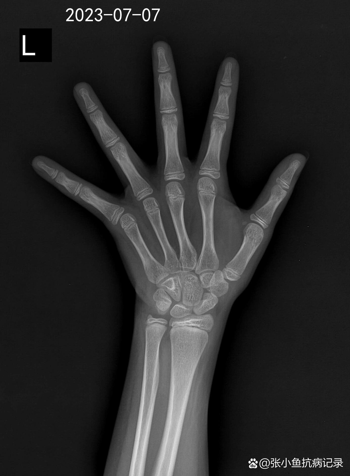 骨龄已经开始闭合还能长高吗?