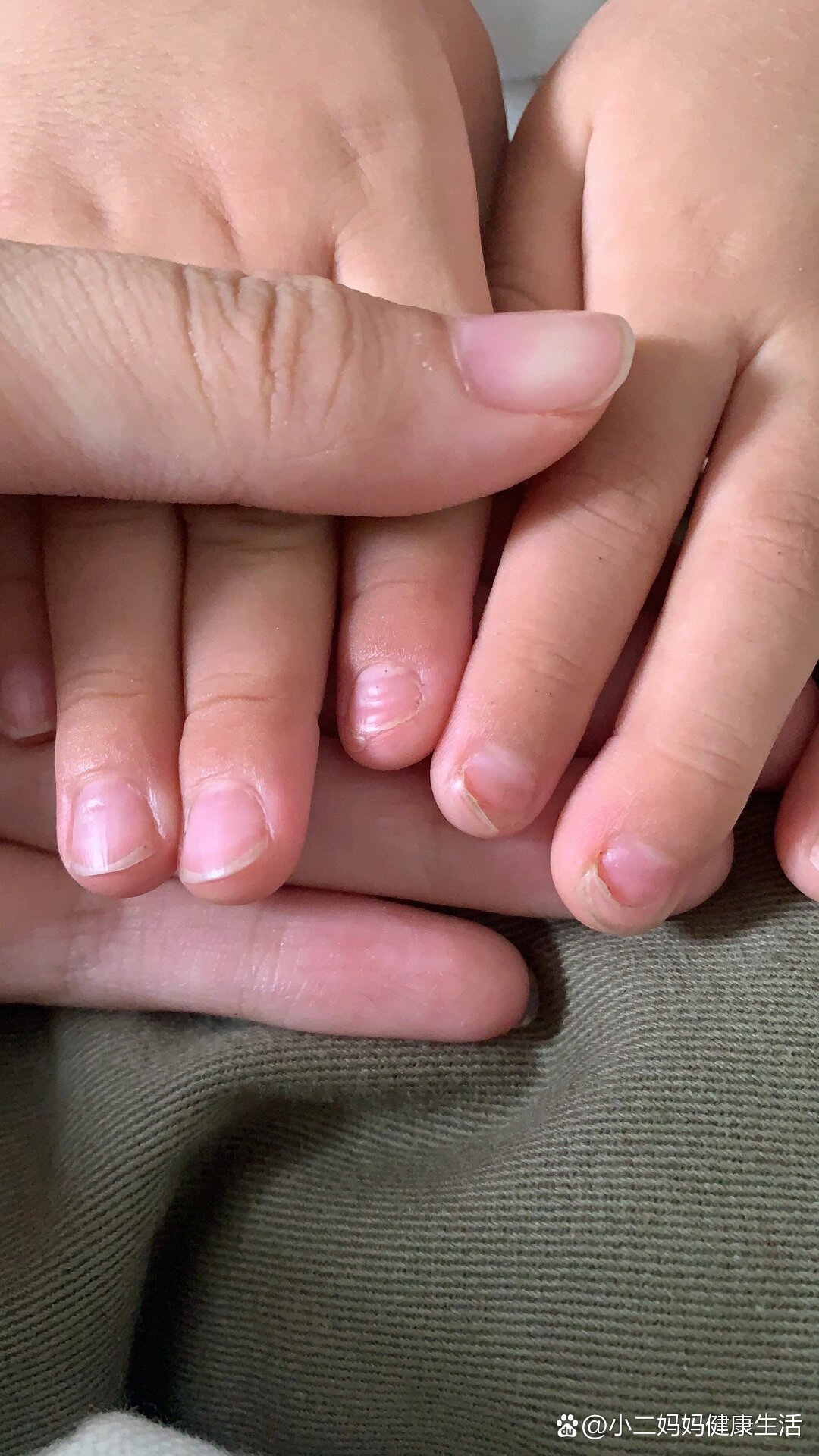 手足口后一个月开始掉指甲