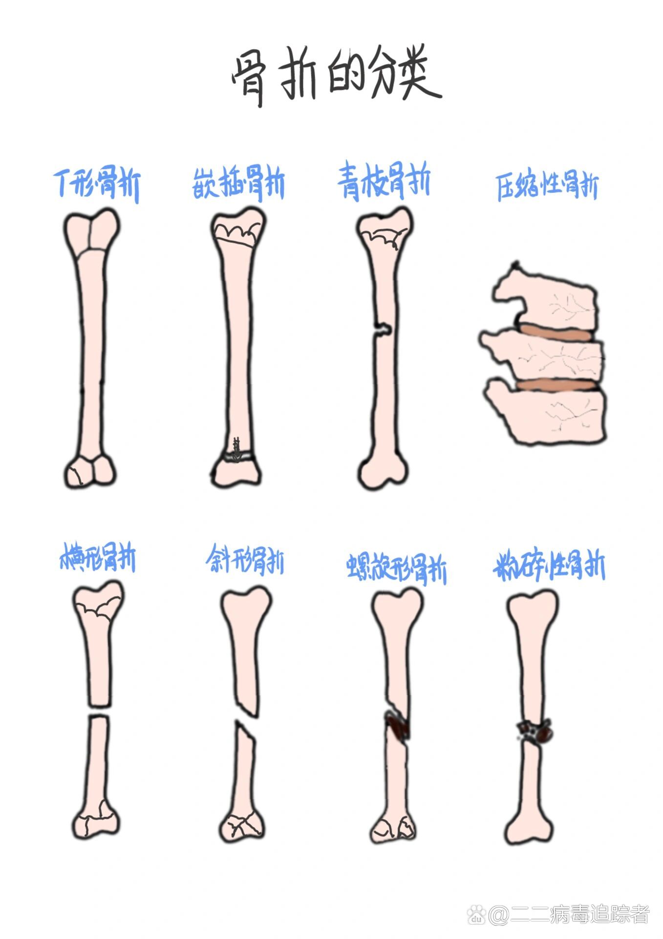 护理笔记|骨折