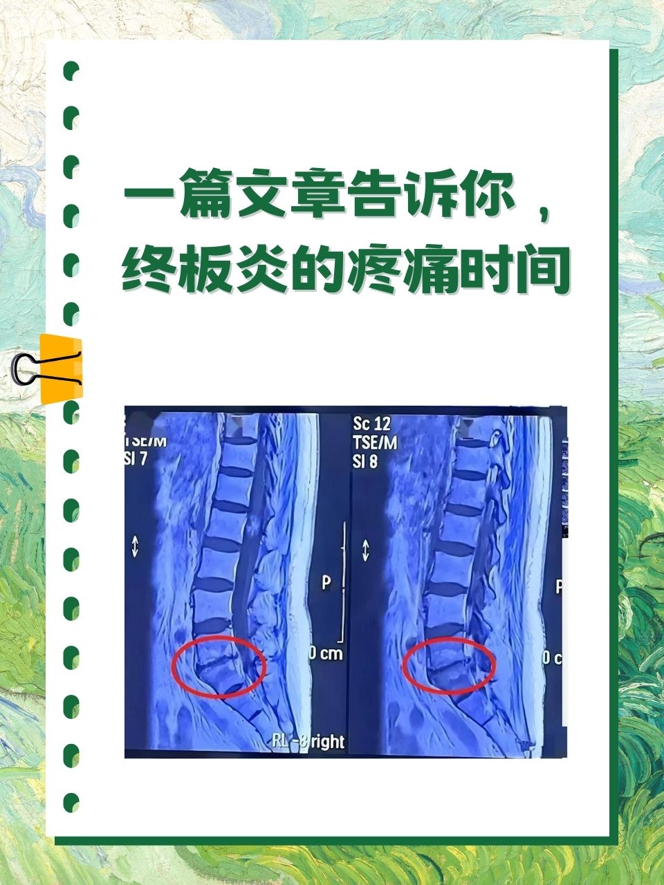 一篇文章告诉你,终板炎的疼痛时间