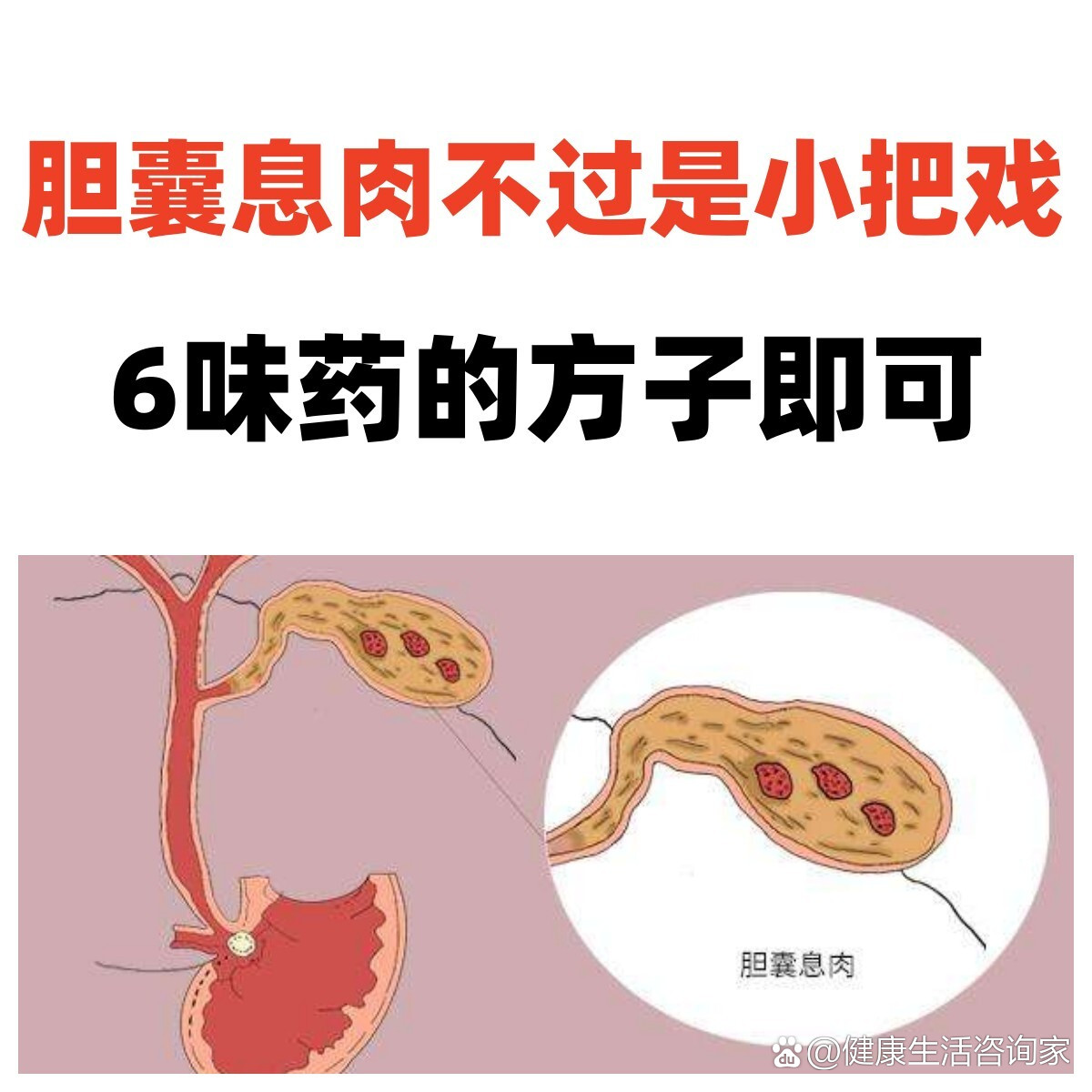 胆囊息肉小偏方图片