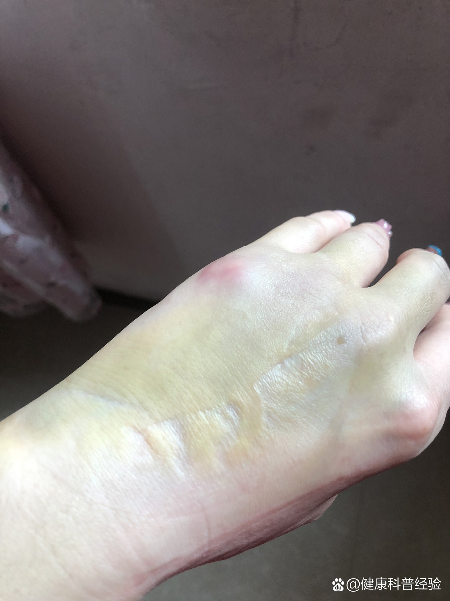 小拇指不能弯曲,骨头凸起没有恢复原状,是不是又要进行手术治疗了