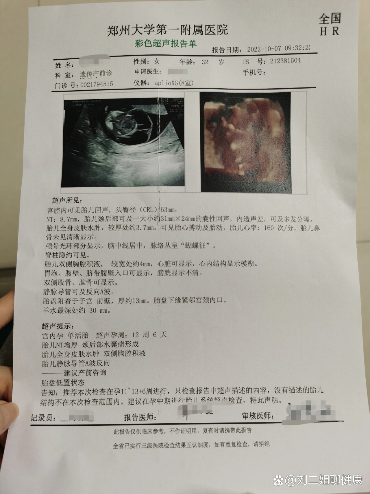 胎儿颈部水囊瘤 胸腔积液 全身水肿.