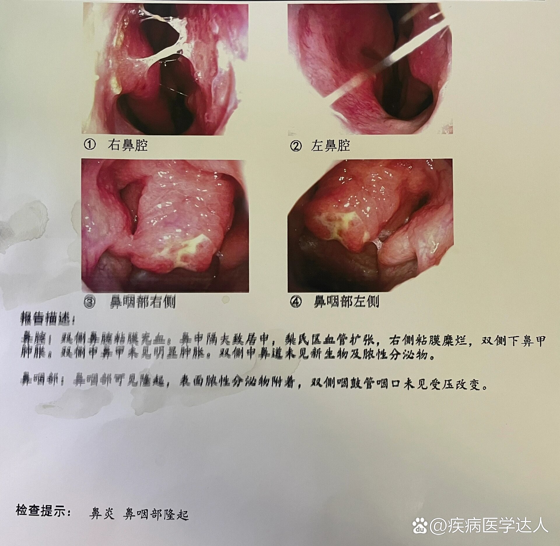 正常的鼻咽部平面图片图片