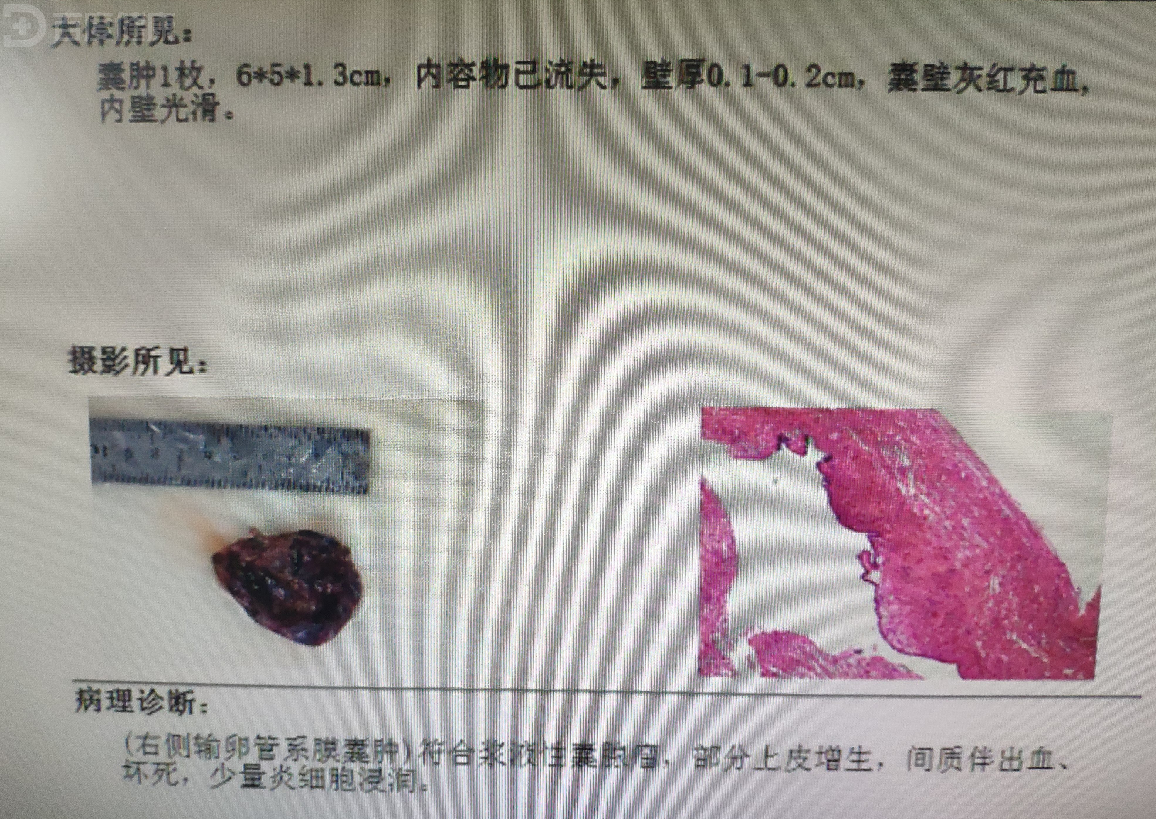 腹痛发现输卵管和输卵管系膜囊肿扭转,及时手术治愈