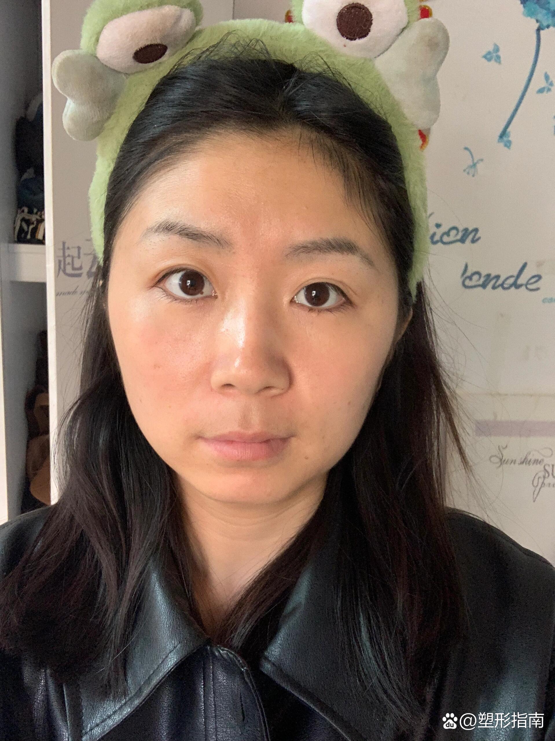 关节紊乱导致的歪脸可以做筷子操吗 br>原相机里的自己简直了,大小脸