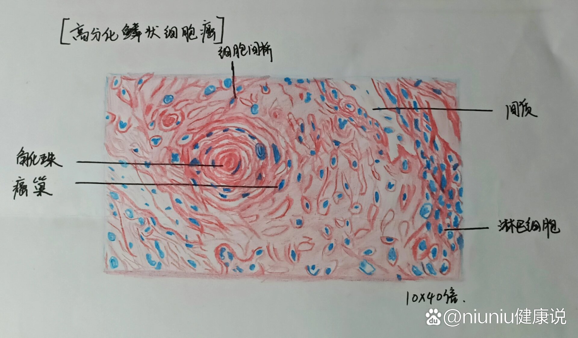 绒毛膜癌红蓝铅笔绘图图片