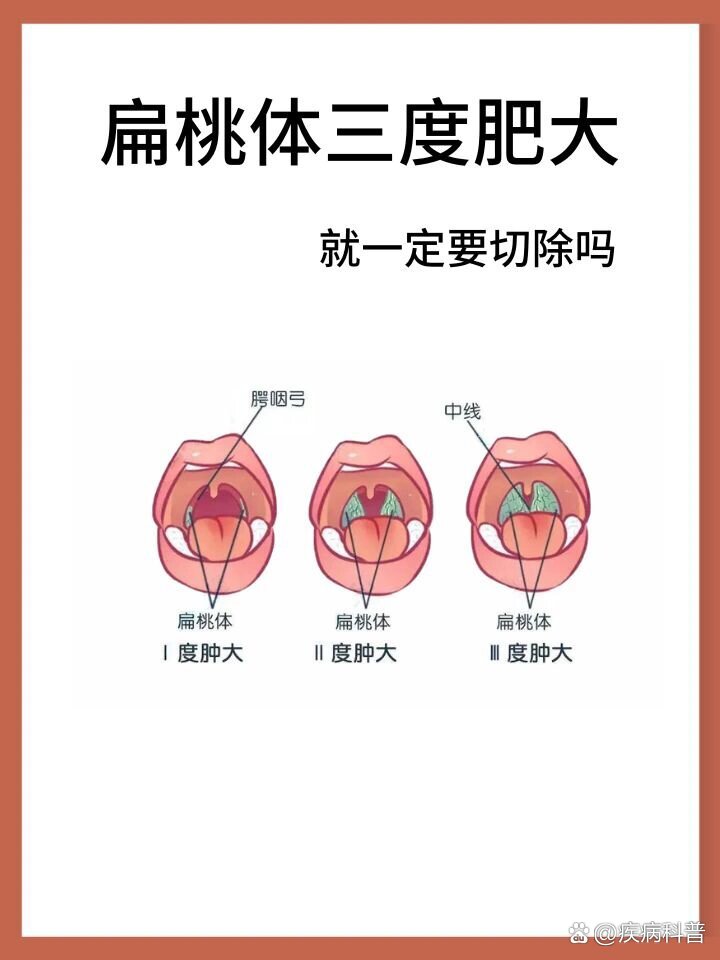 扁桃体三度肥大切or不切?